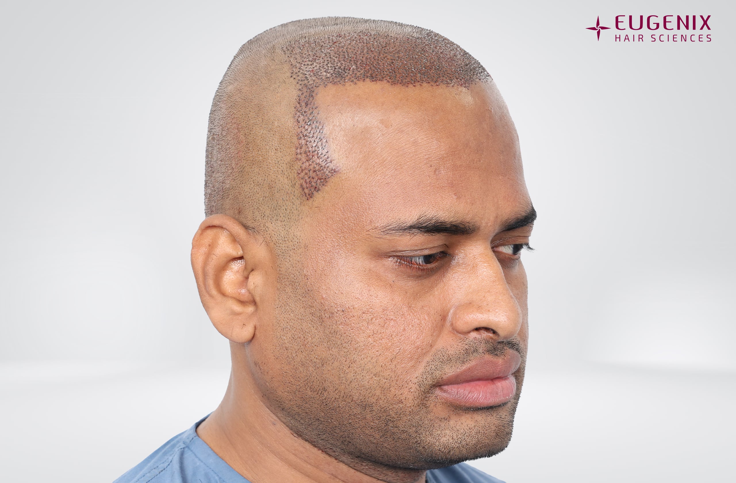 Kolanupaka Vishnu Vardhan Post-op Left copy