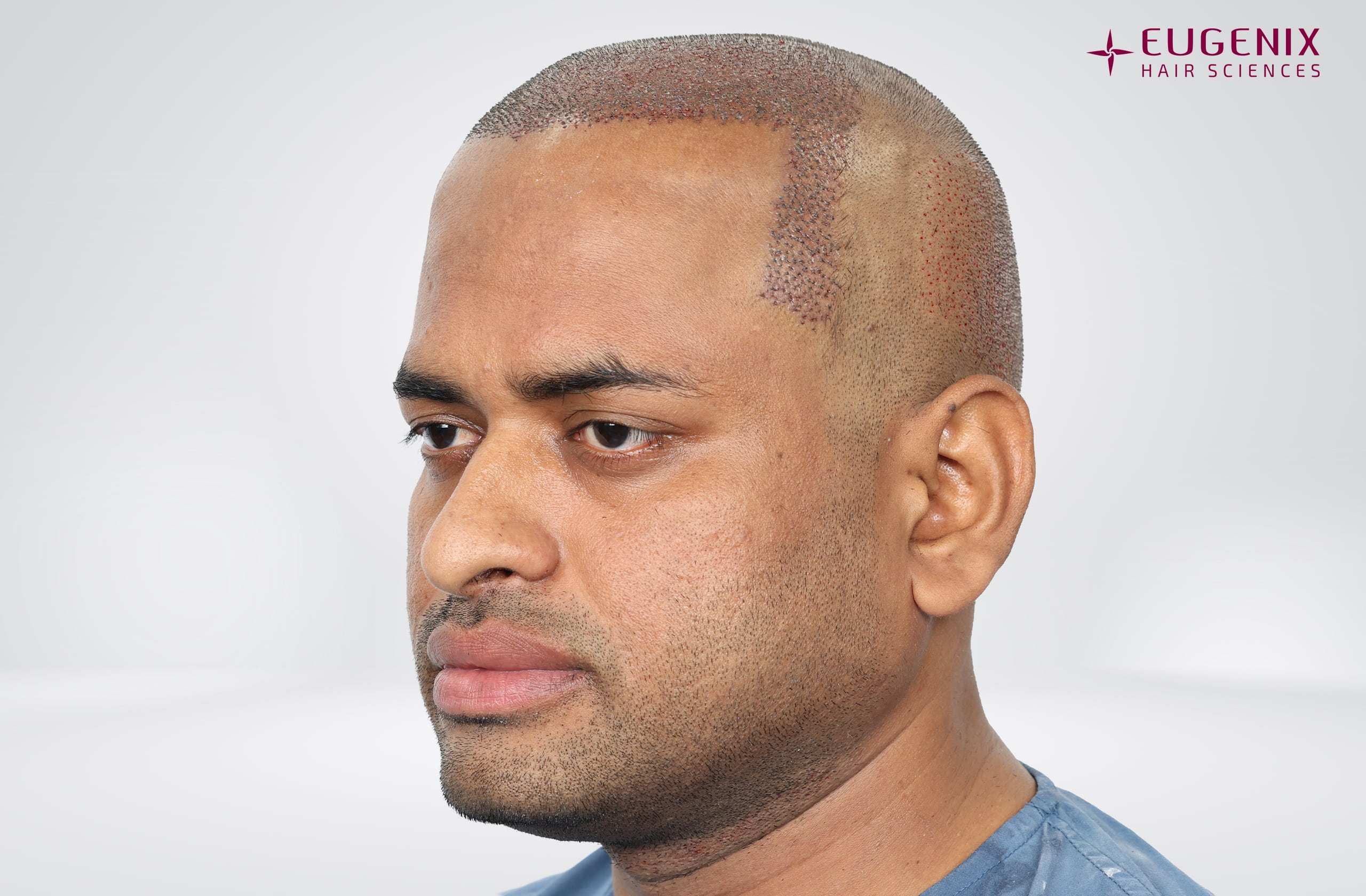 Kolanupaka Vishnu Vardhan Post-op Right copy