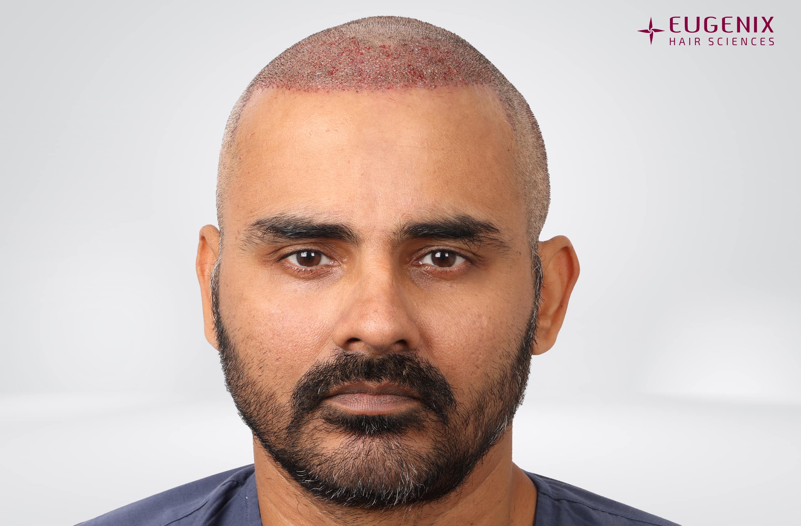 Nikhil Bir Singh Cheema Post-op Front copy