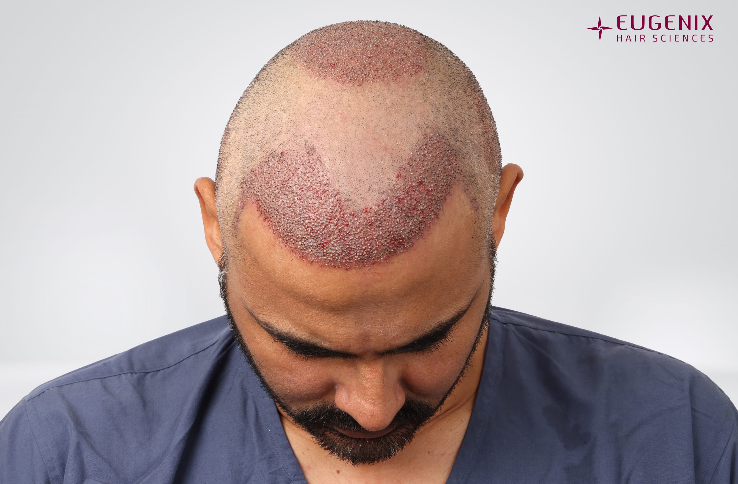 Nikhil Bir Singh Cheema Post-op Head Down copy