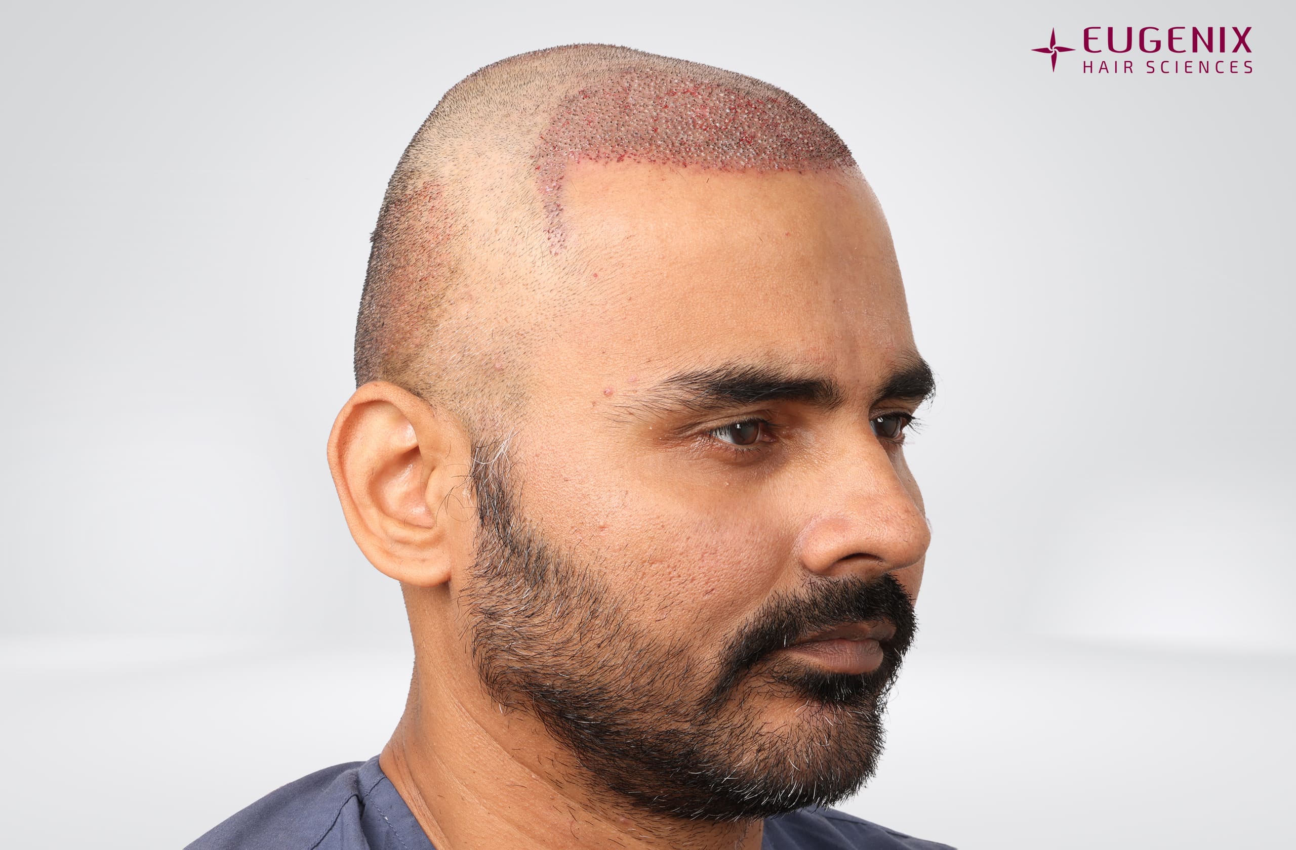 Nikhil Bir Singh Cheema Post-op Left copy