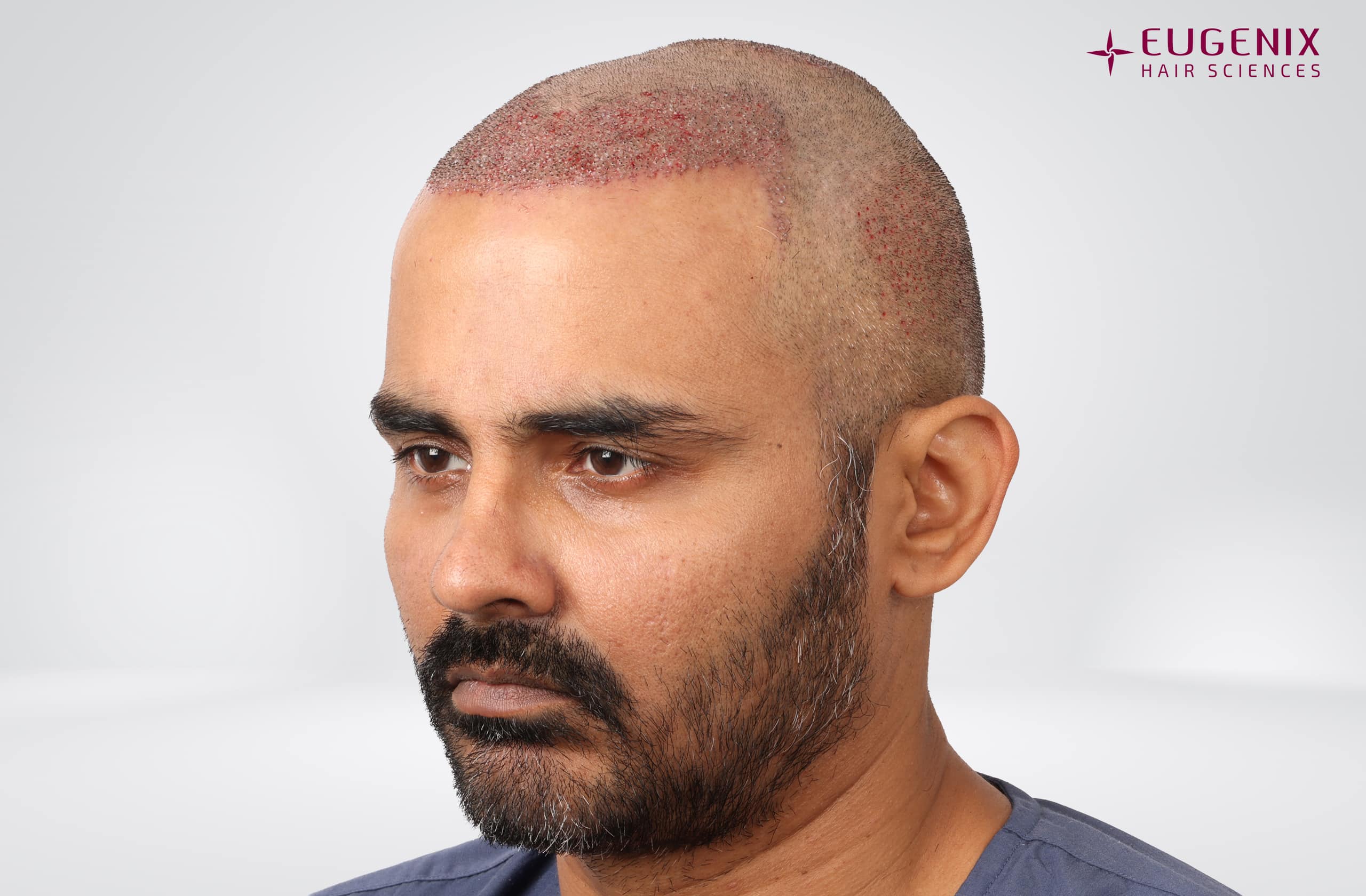 Nikhil Bir Singh Cheema Post-op Right copy