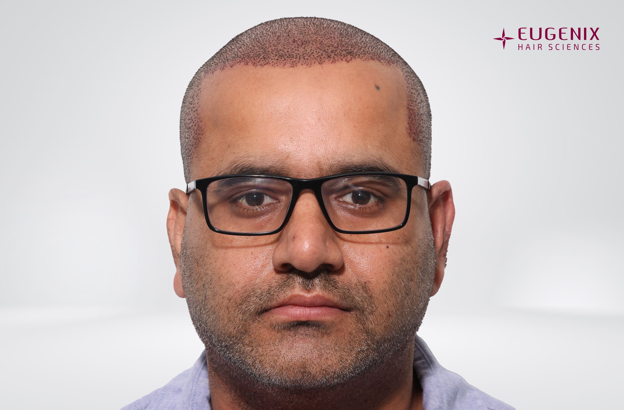 Saurabh Kaushish Post-op Front copy