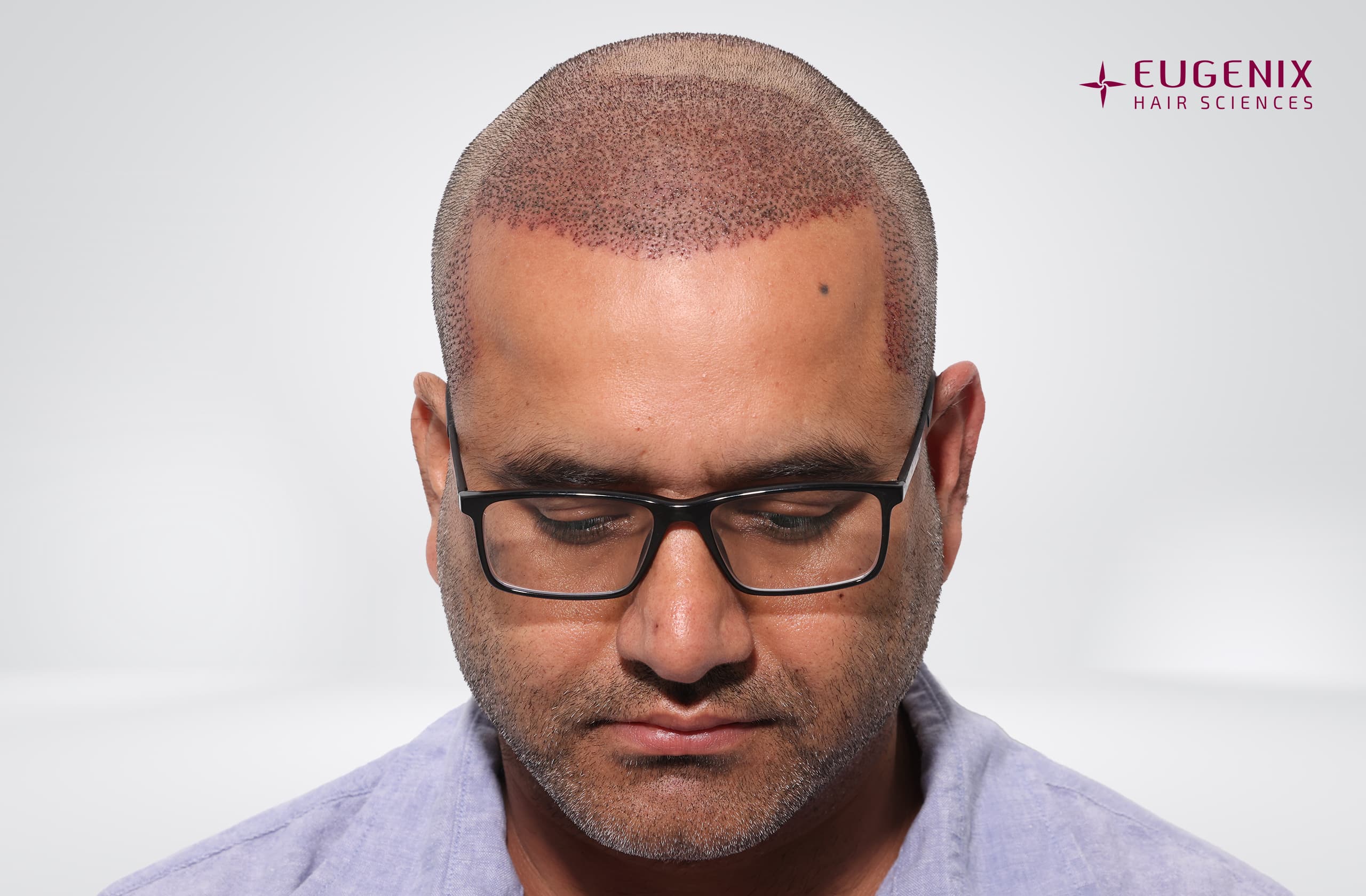 Saurabh Kaushish Post-op Head Down copy