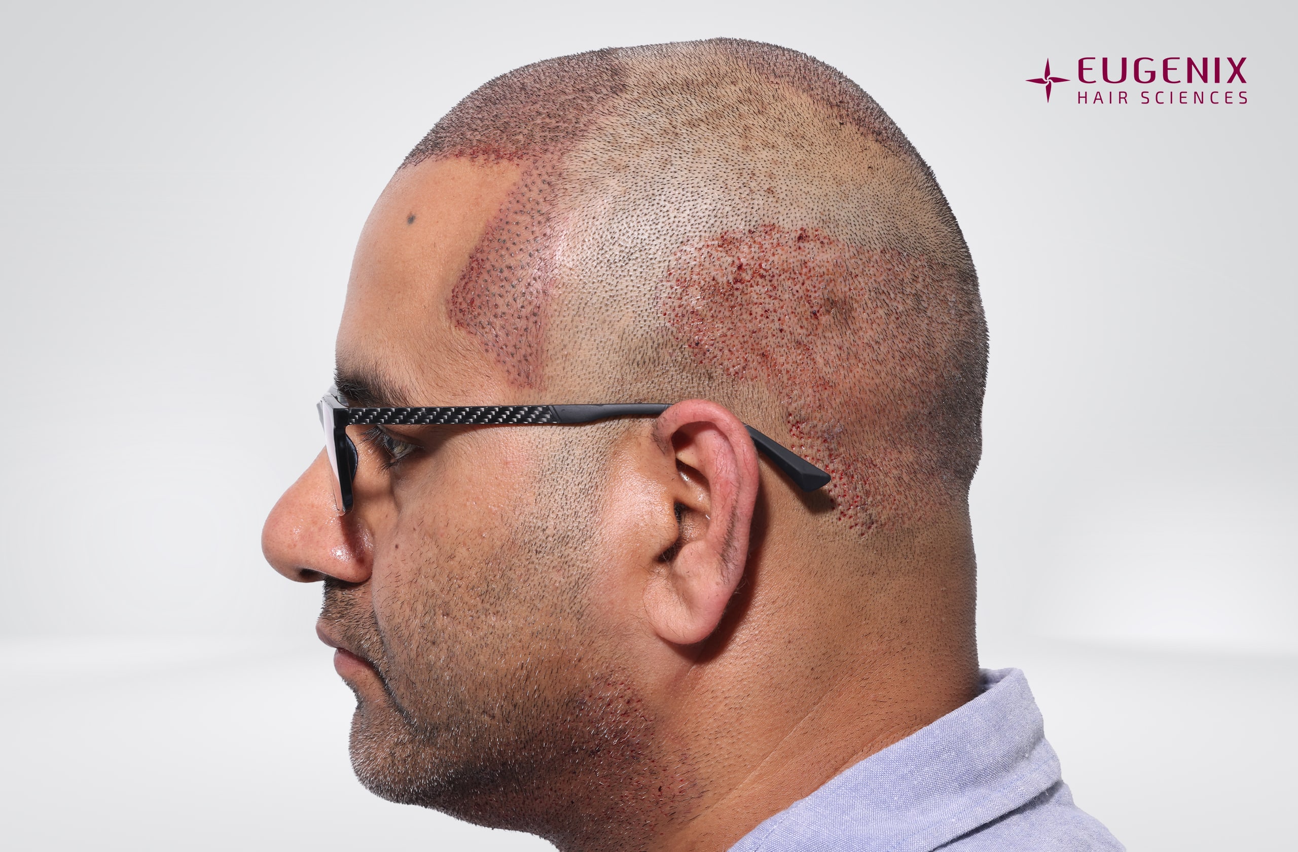 Saurabh Kaushish Post-op Right copy