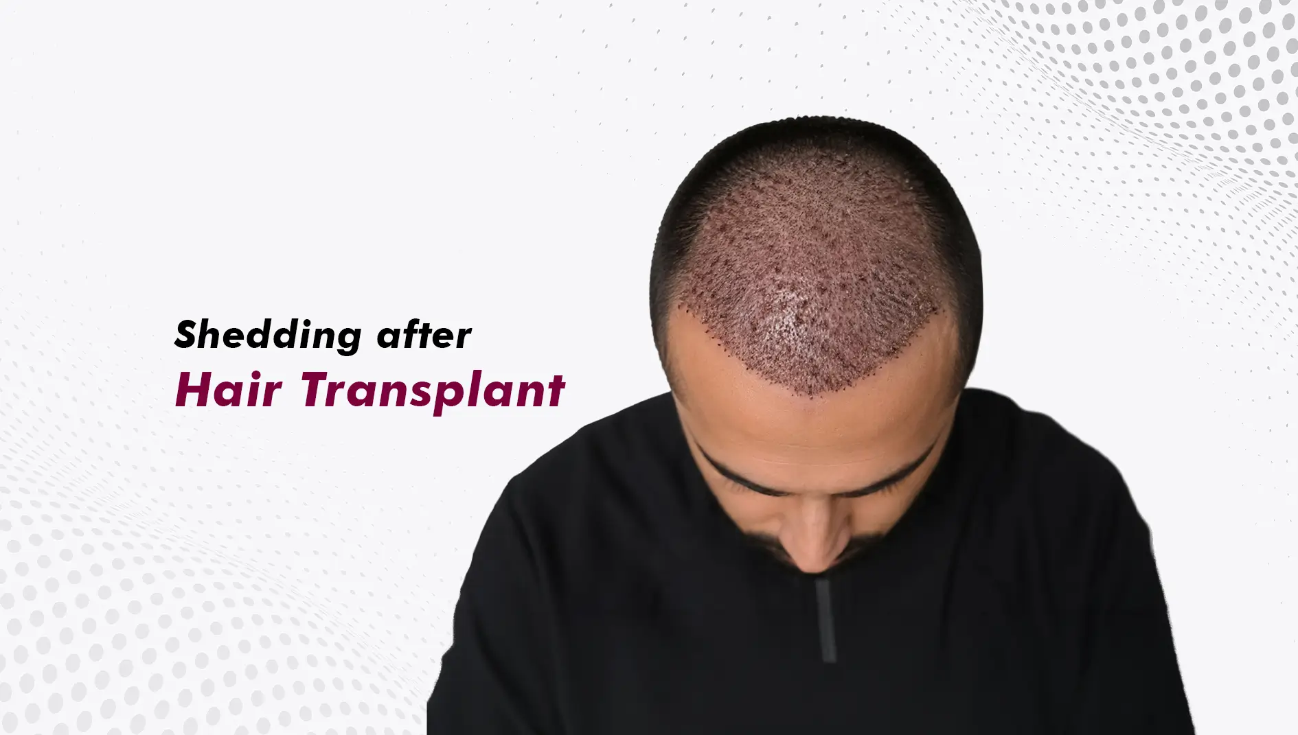 Shedding After Hair Transplant: What Is Normal, What Is Shock Loss, and When to Worry