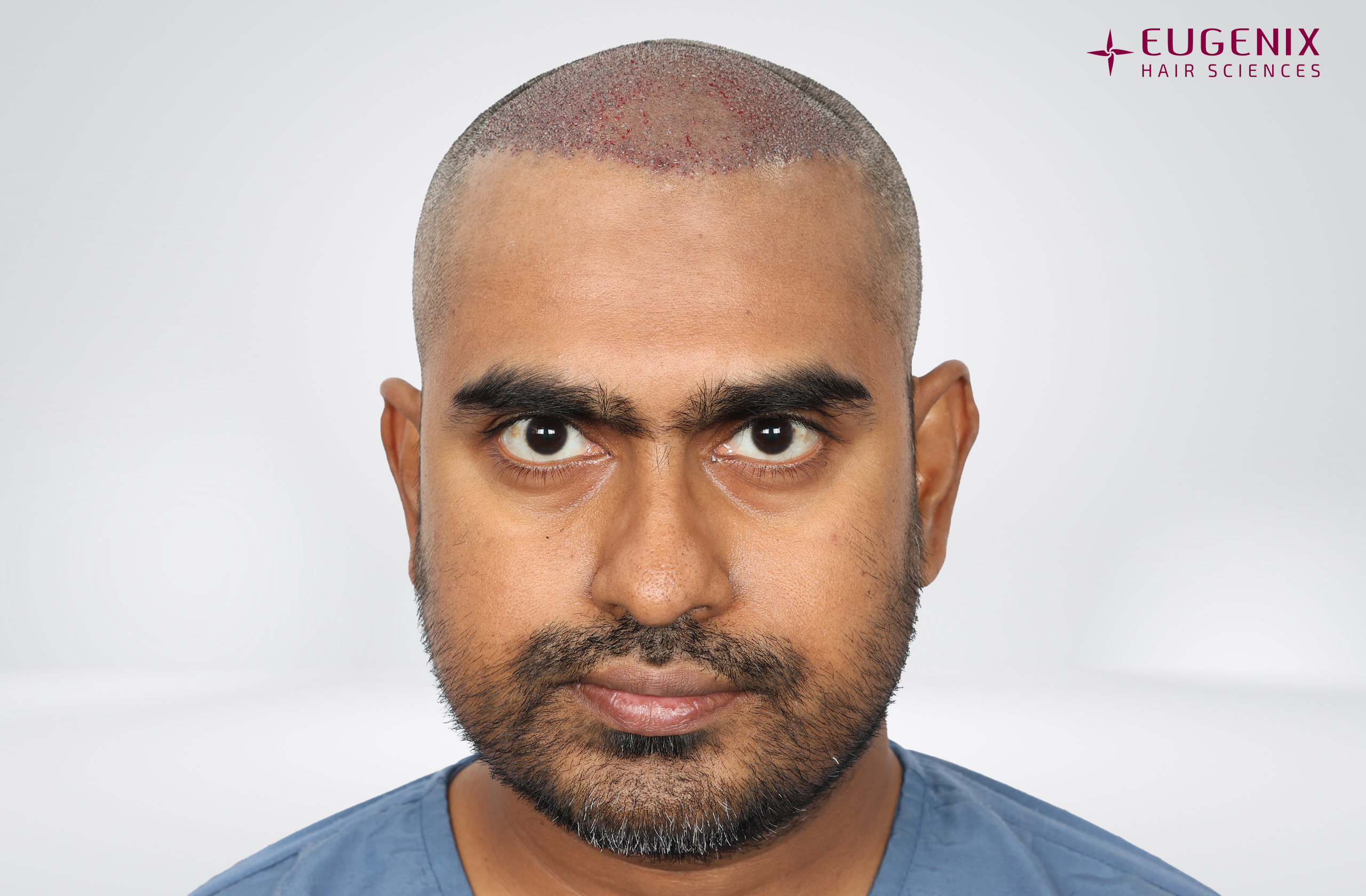 Vishal Post-op Front copy