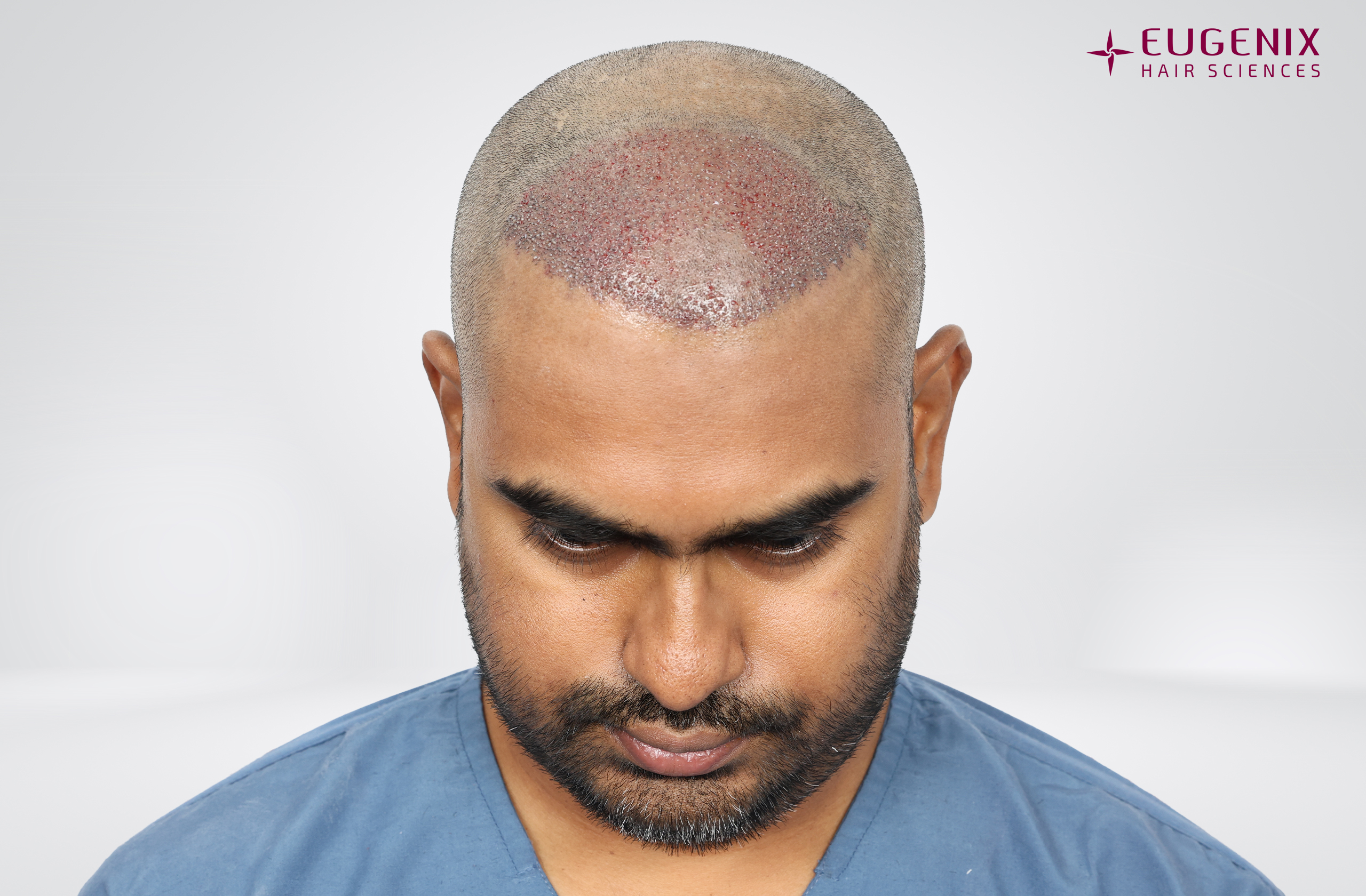 Vishal Post-op Head Down copy