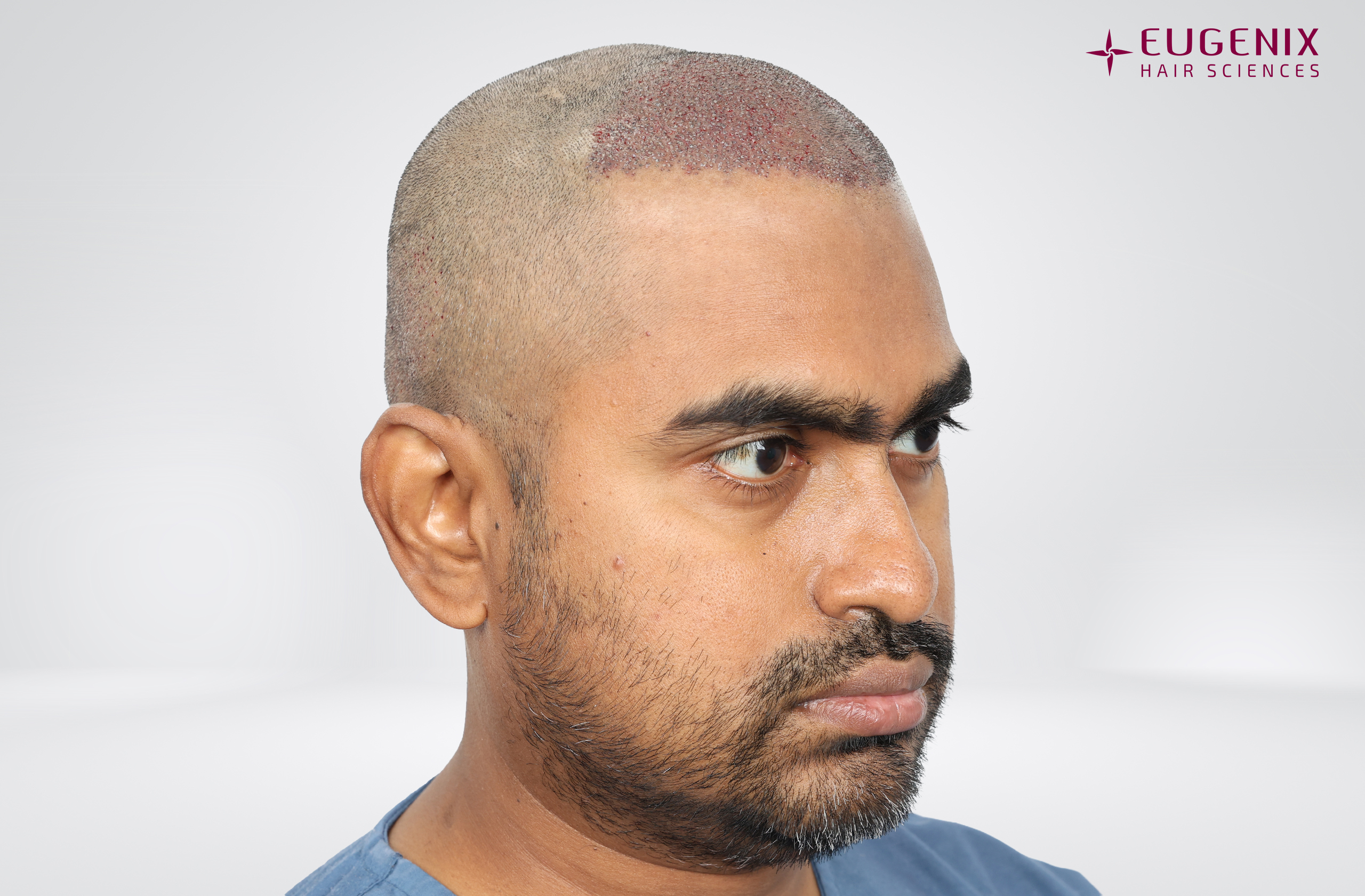 Vishal Post-op Left copy