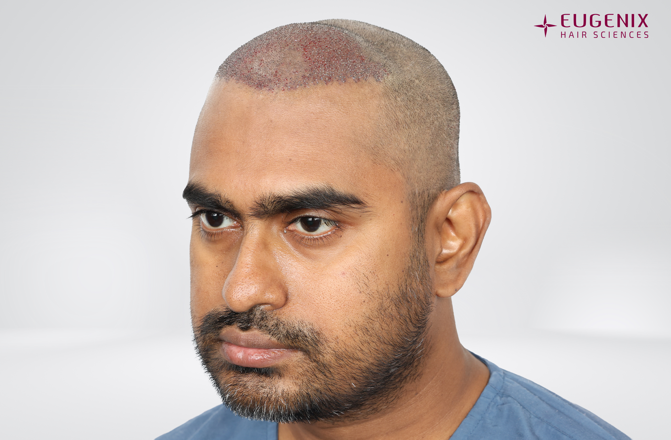 Vishal Post-op Right copy