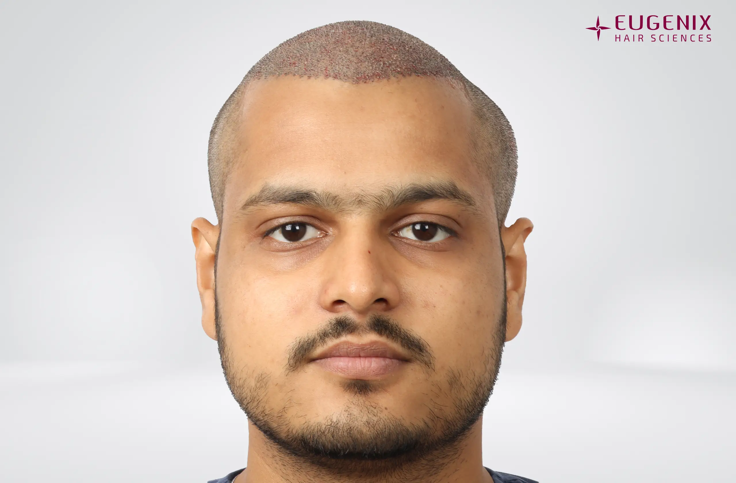 Abhay Khandloya Post-op Front copy