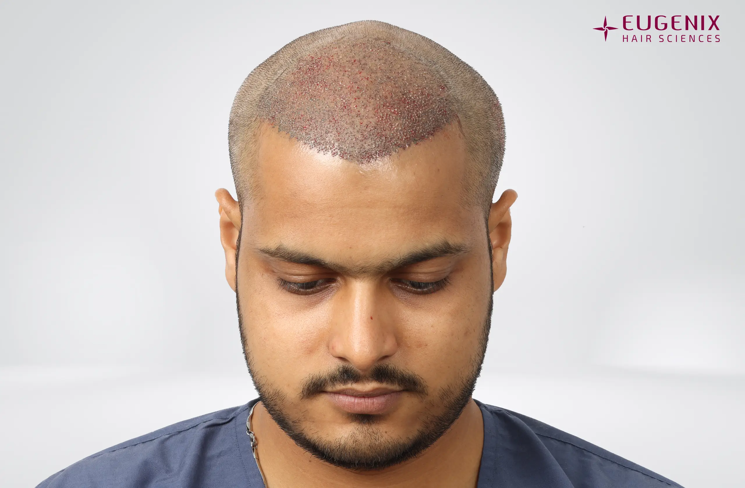 Abhay Khandloya Post-op Head Down copy
