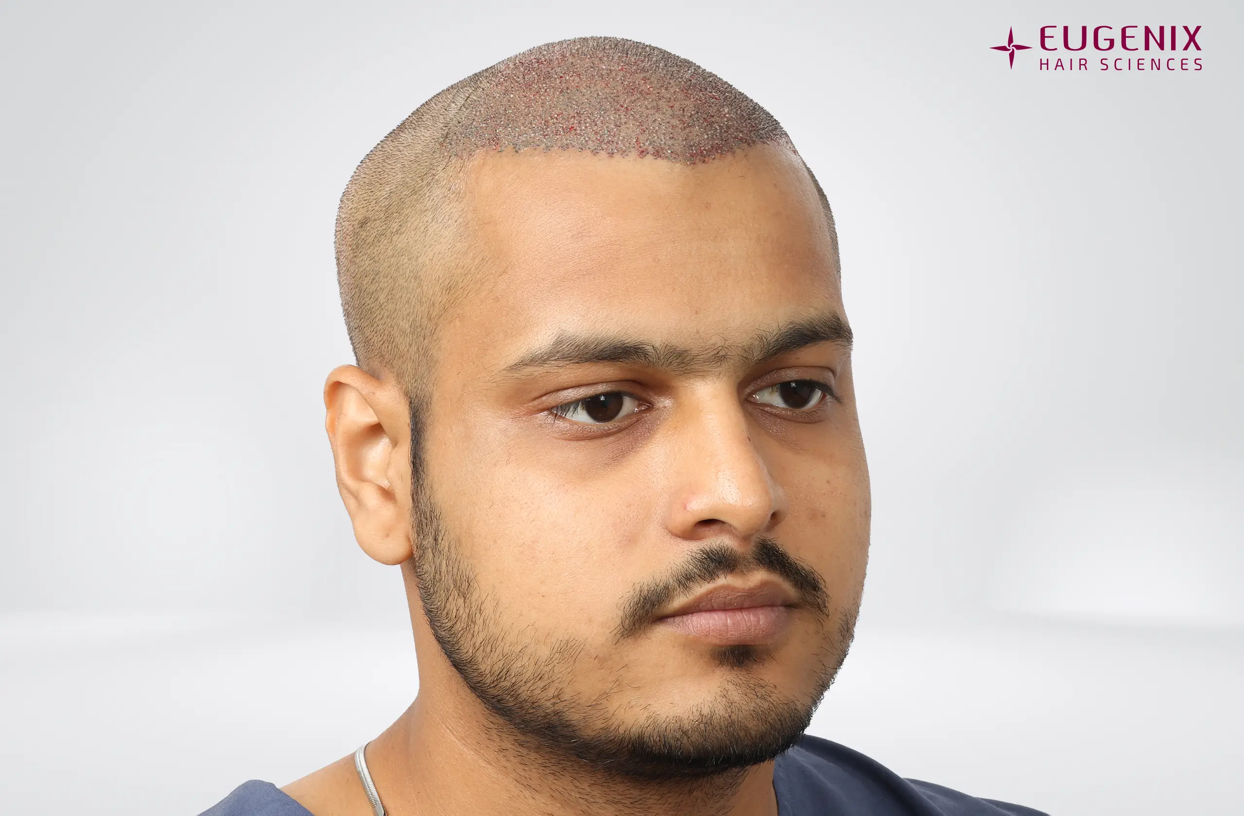 Abhay Khandloya Post-op Left copy