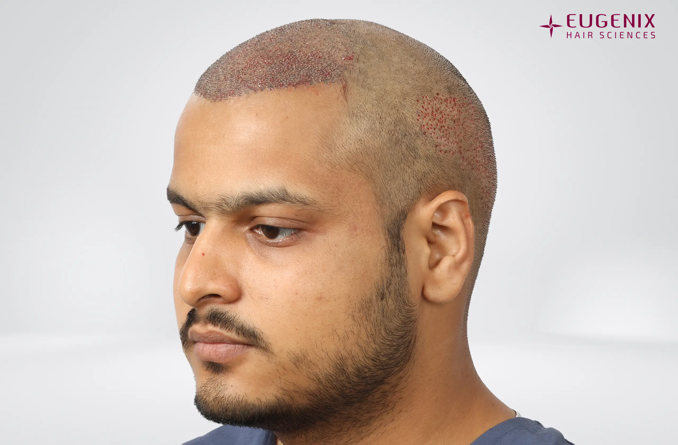 Abhay Khandloya Post-op Right copy
