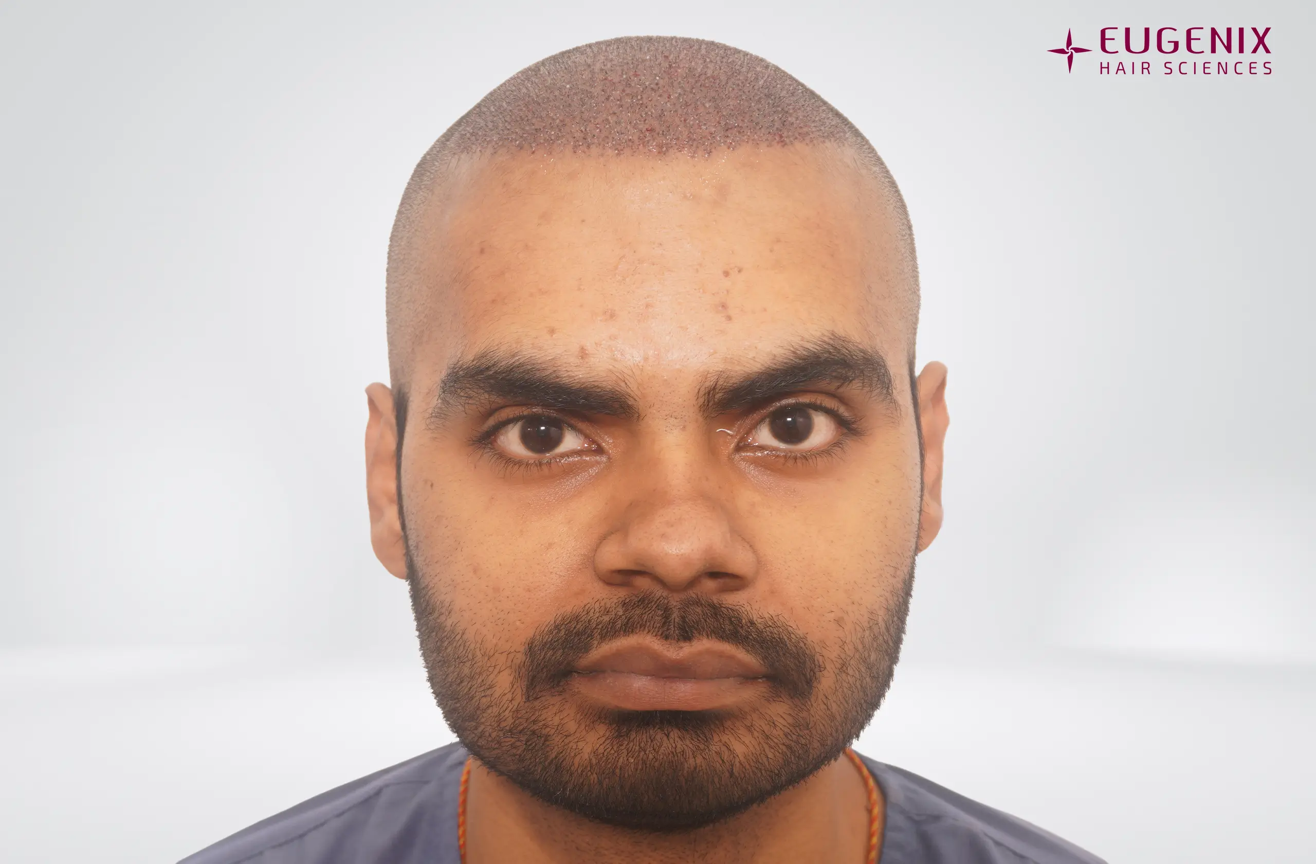 Apporv Jha Post-op Front copy
