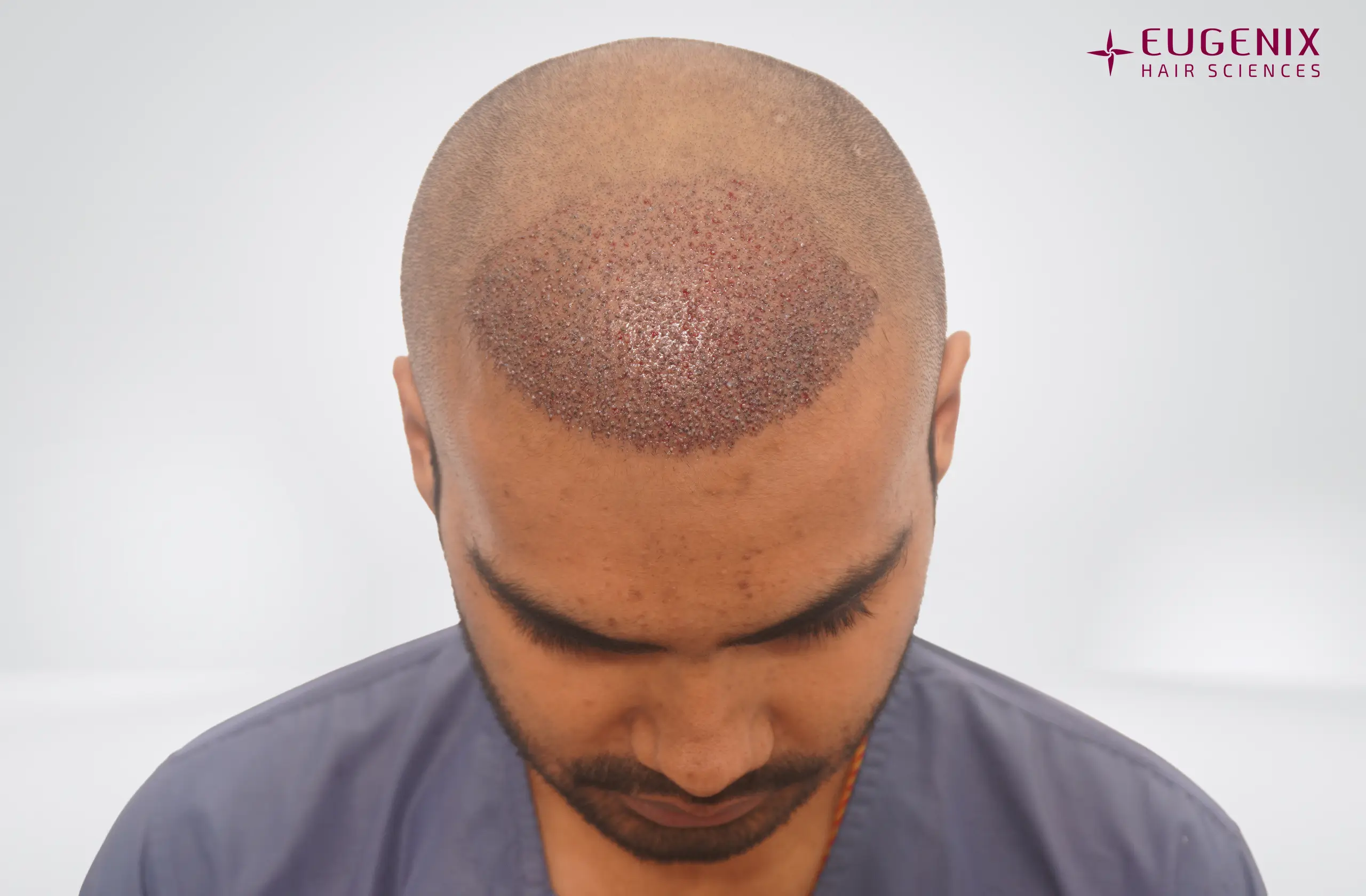 Apporv Jha Post-op Head Down copy