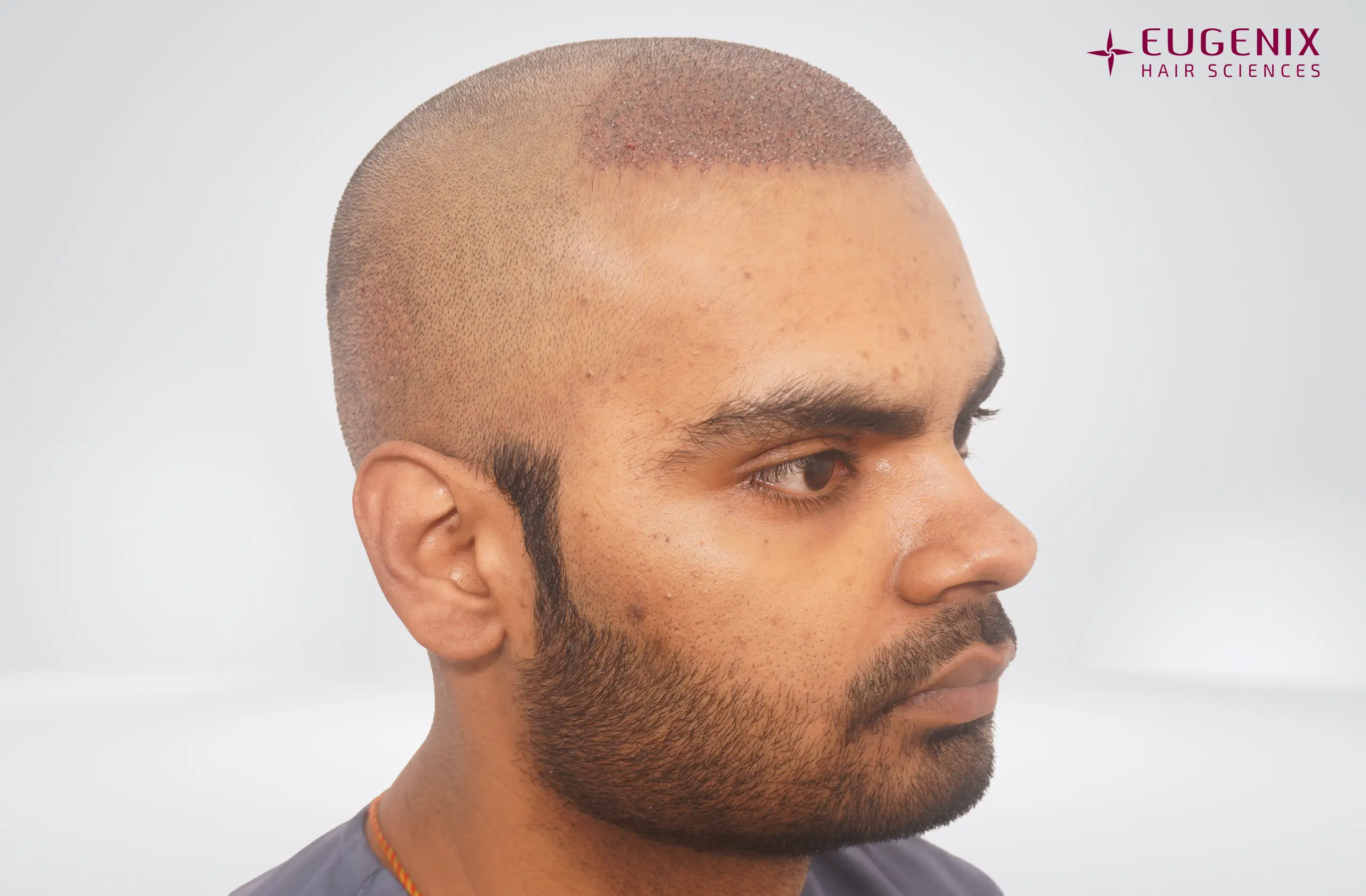 Apporv Jha Post-op Left copy