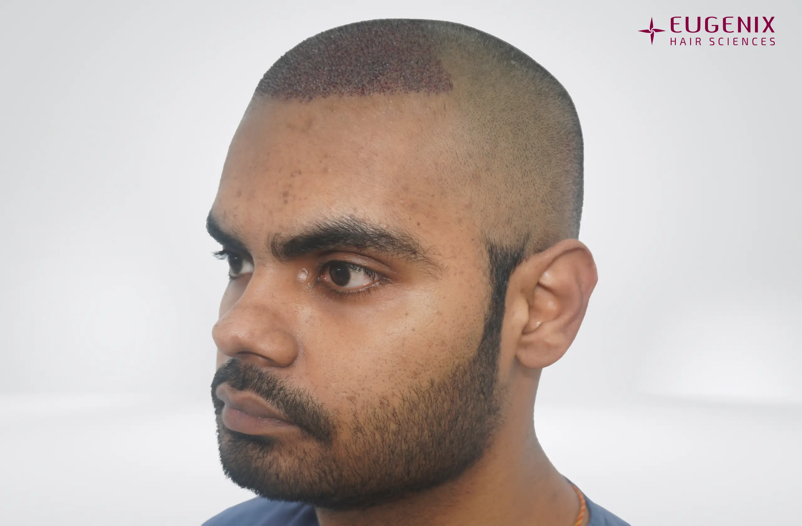 Apporv Jha Post-op Right copy