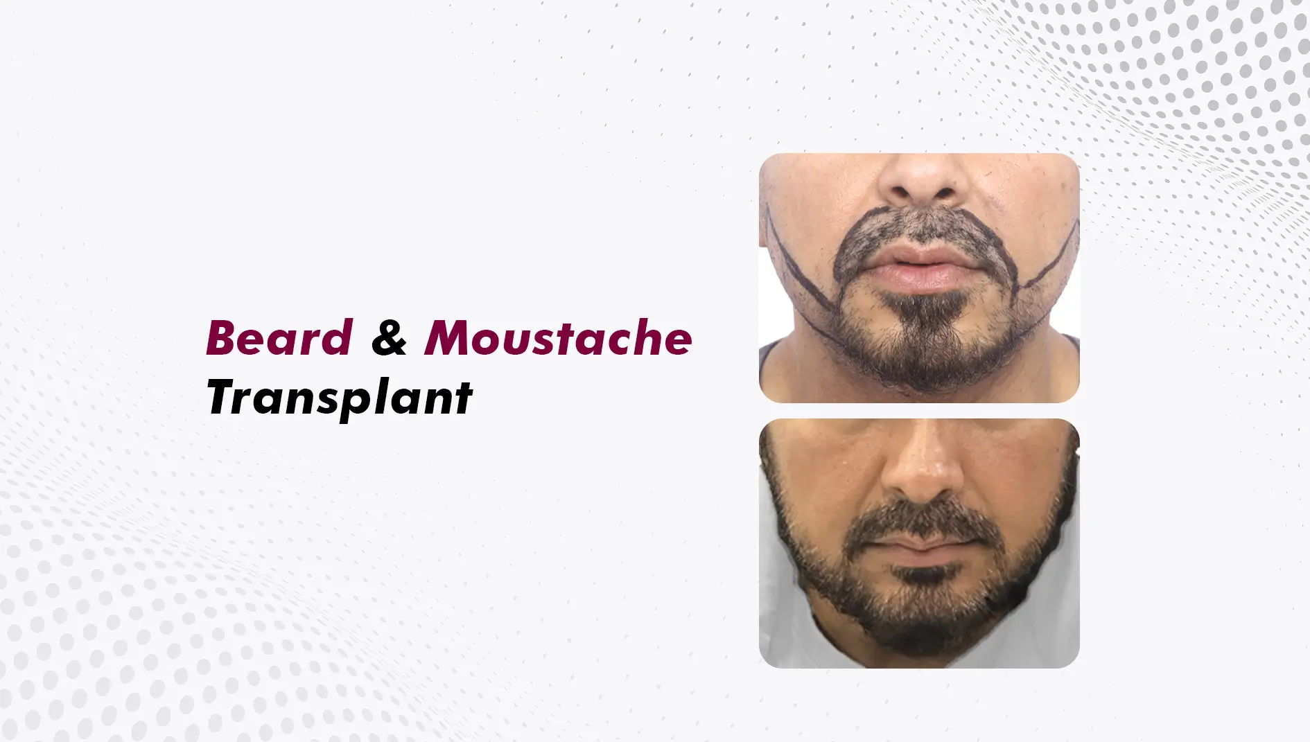 Beard Hair Transplant and Moustache Transplant: A Clinical Guide