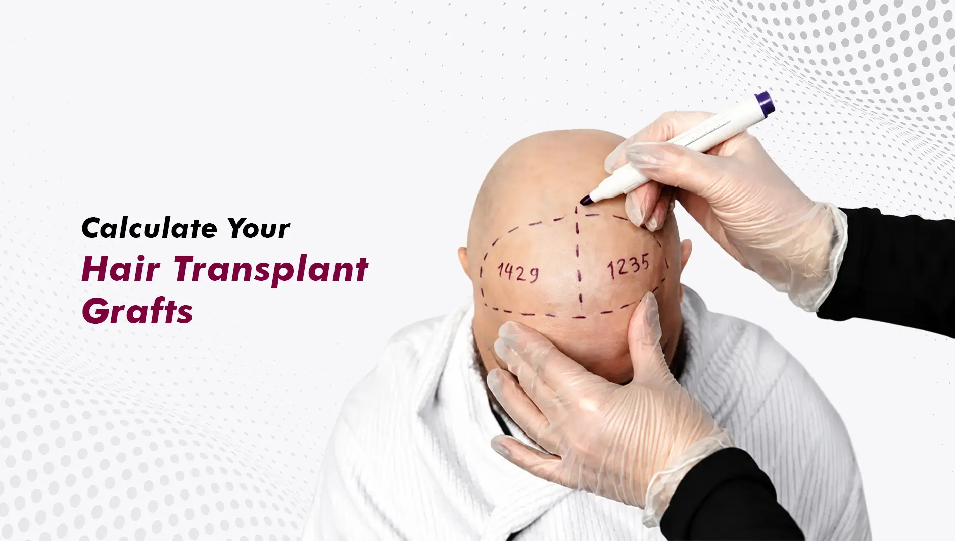 How to Calculate Grafts for Hair Transplant: The Method Behind the Number