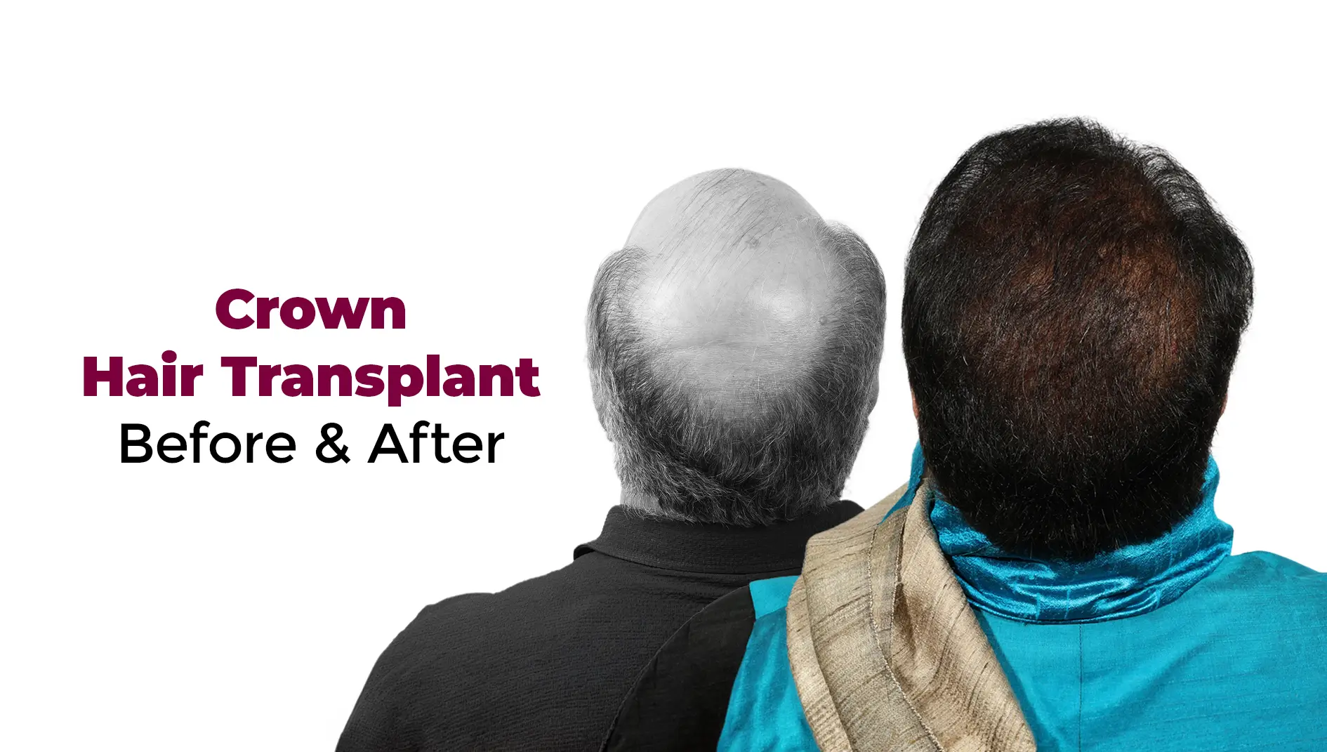 Crown Hair Transplant Before and After: How to Read the Photos Properly