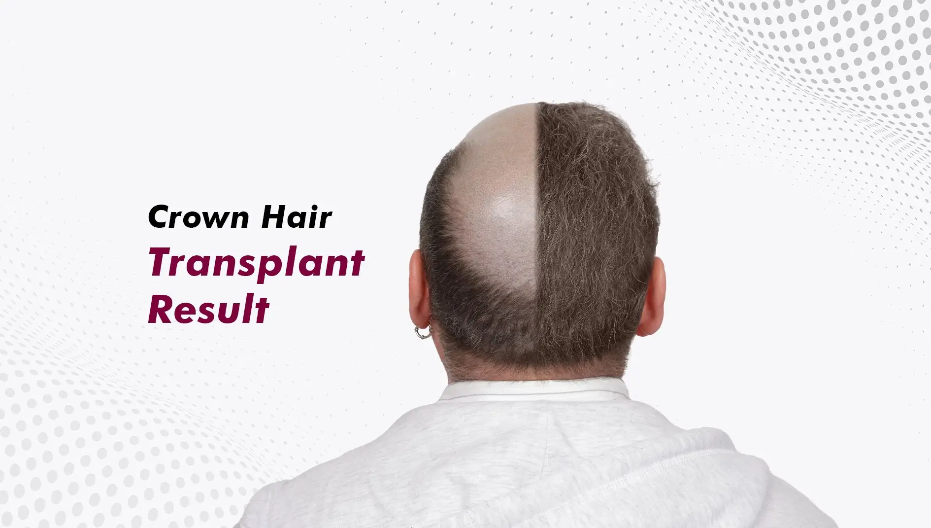 Crown Hair Transplant Results: Why the Crown Is the Last Area to Fill In