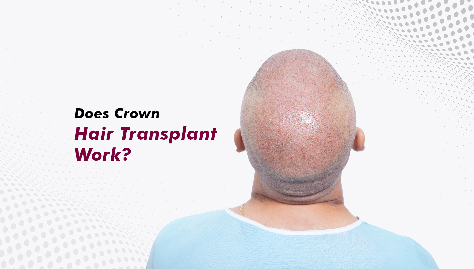 Does Crown Hair Transplant Work? Why Crown Coverage Looks Different From the Hairline