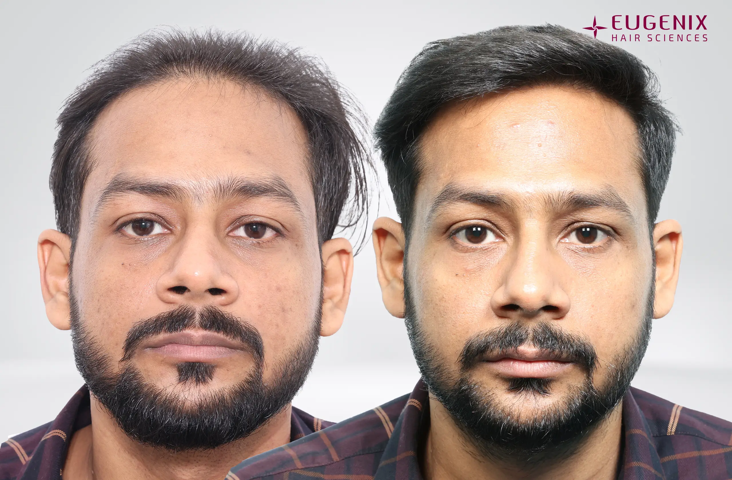Dr. Akash Kumar Before and After Front copy