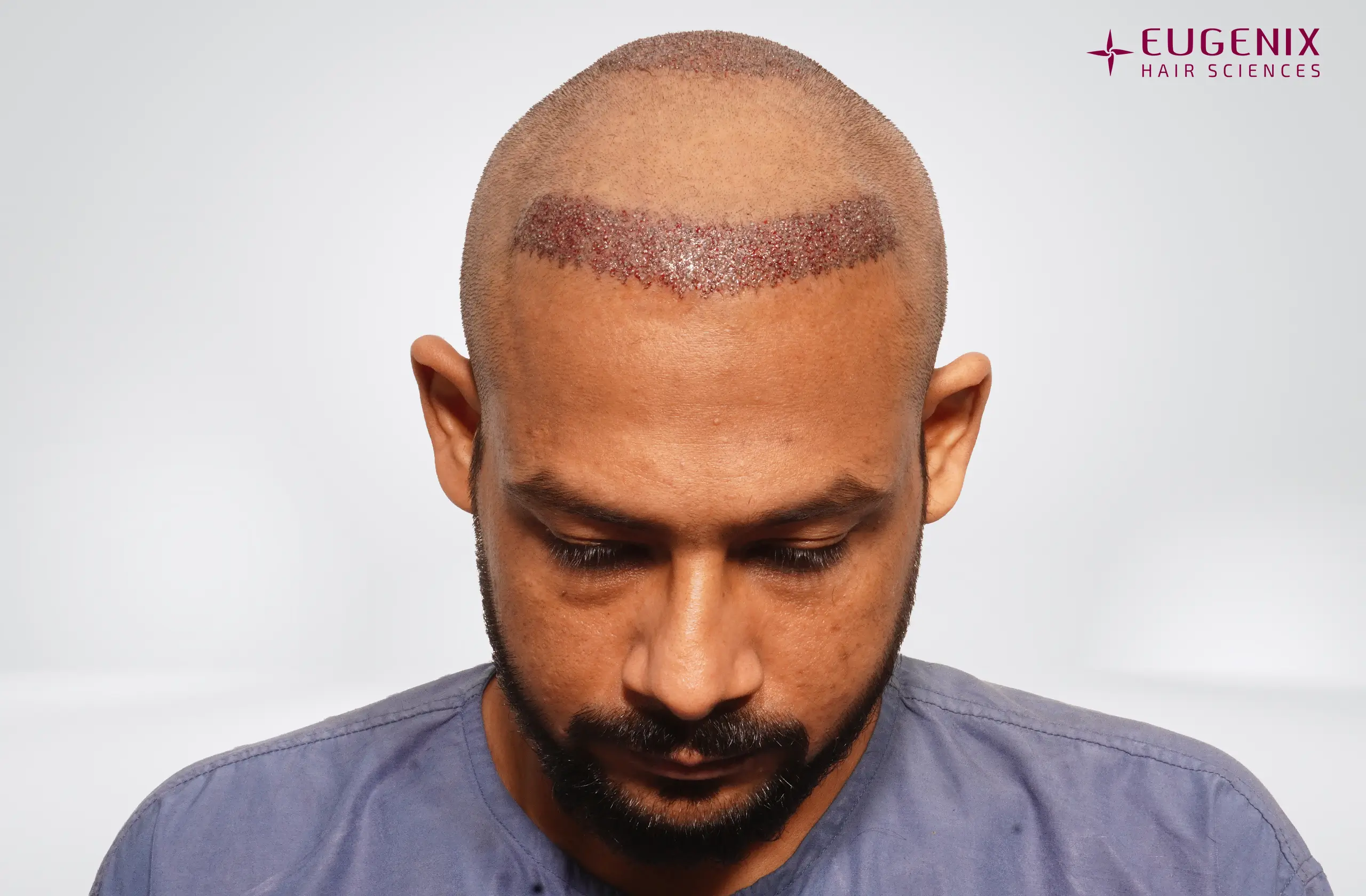 Dr. Akash Kumar Post-op Head Down copy