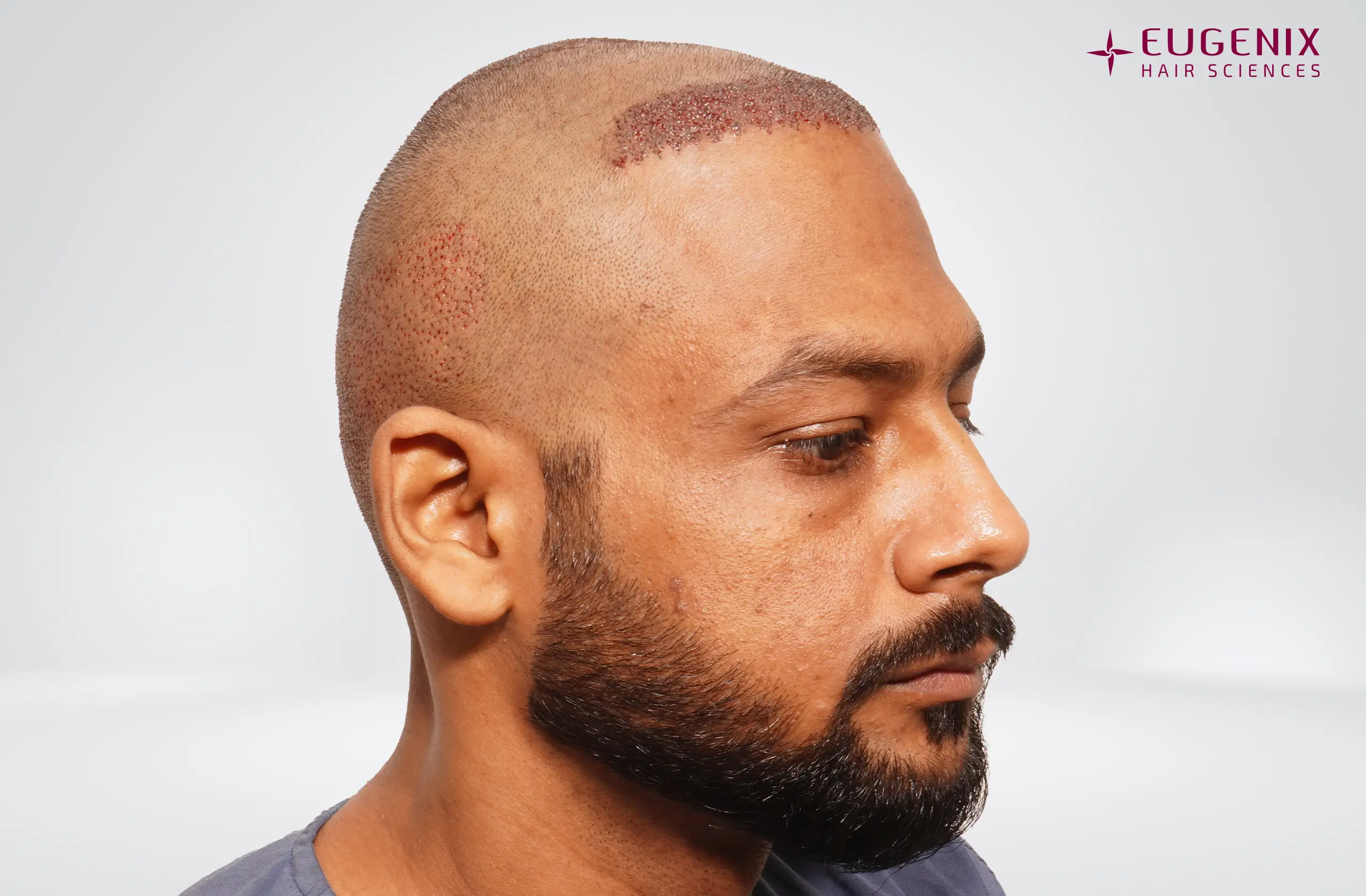 Dr. Akash Kumar Post-op Left copy