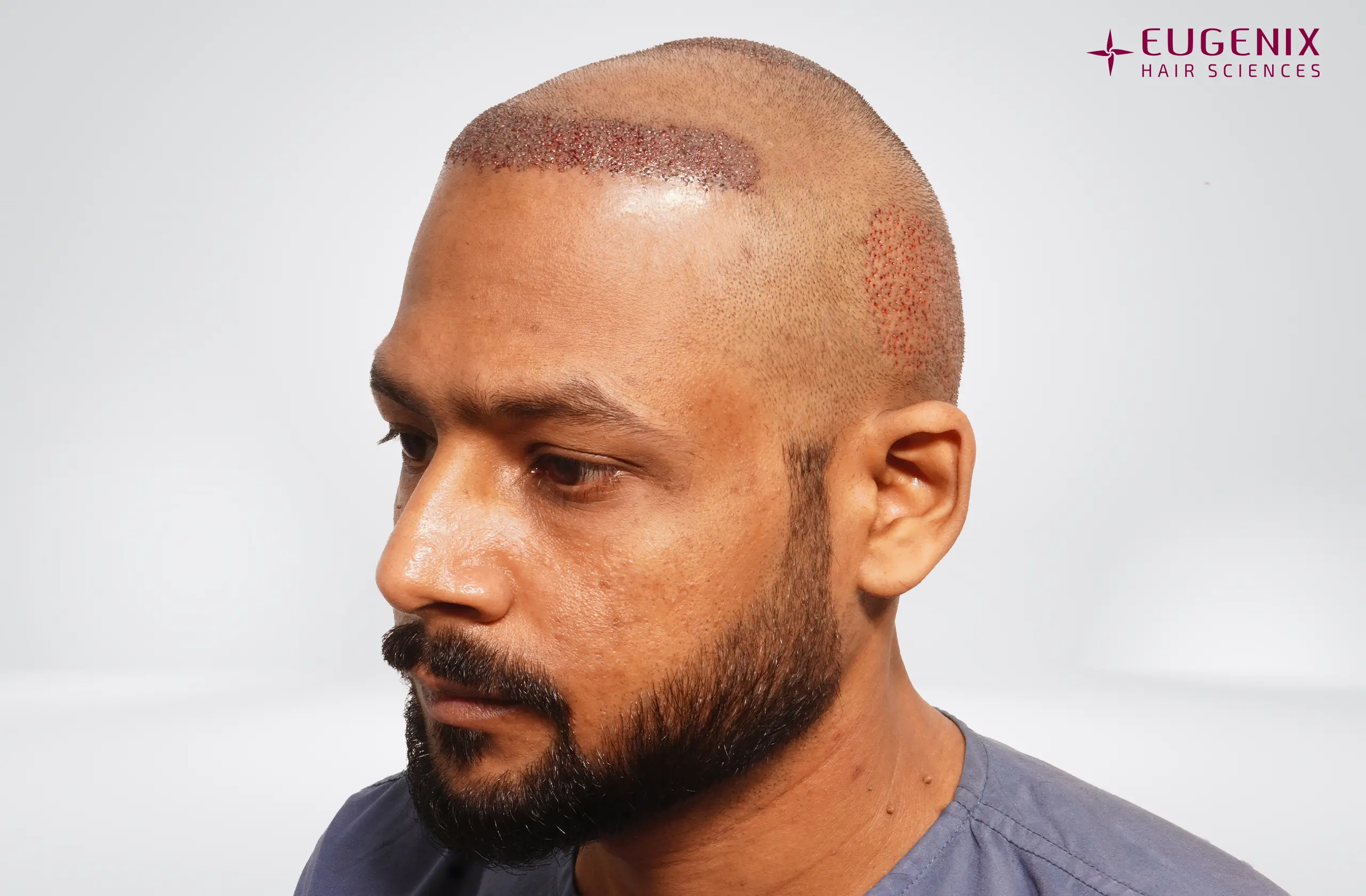 Dr. Akash Kumar Post-op Right copy