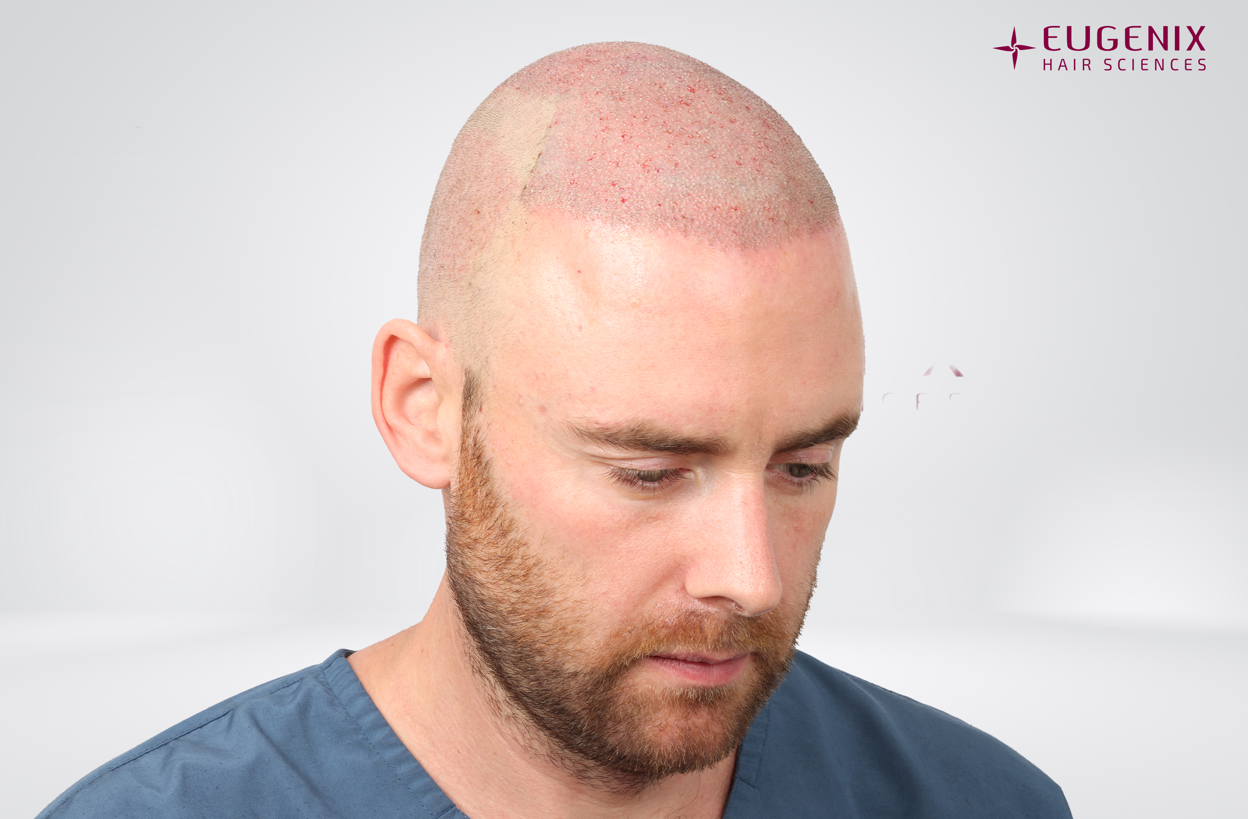 Jamie Scattergood Post-op Left copy