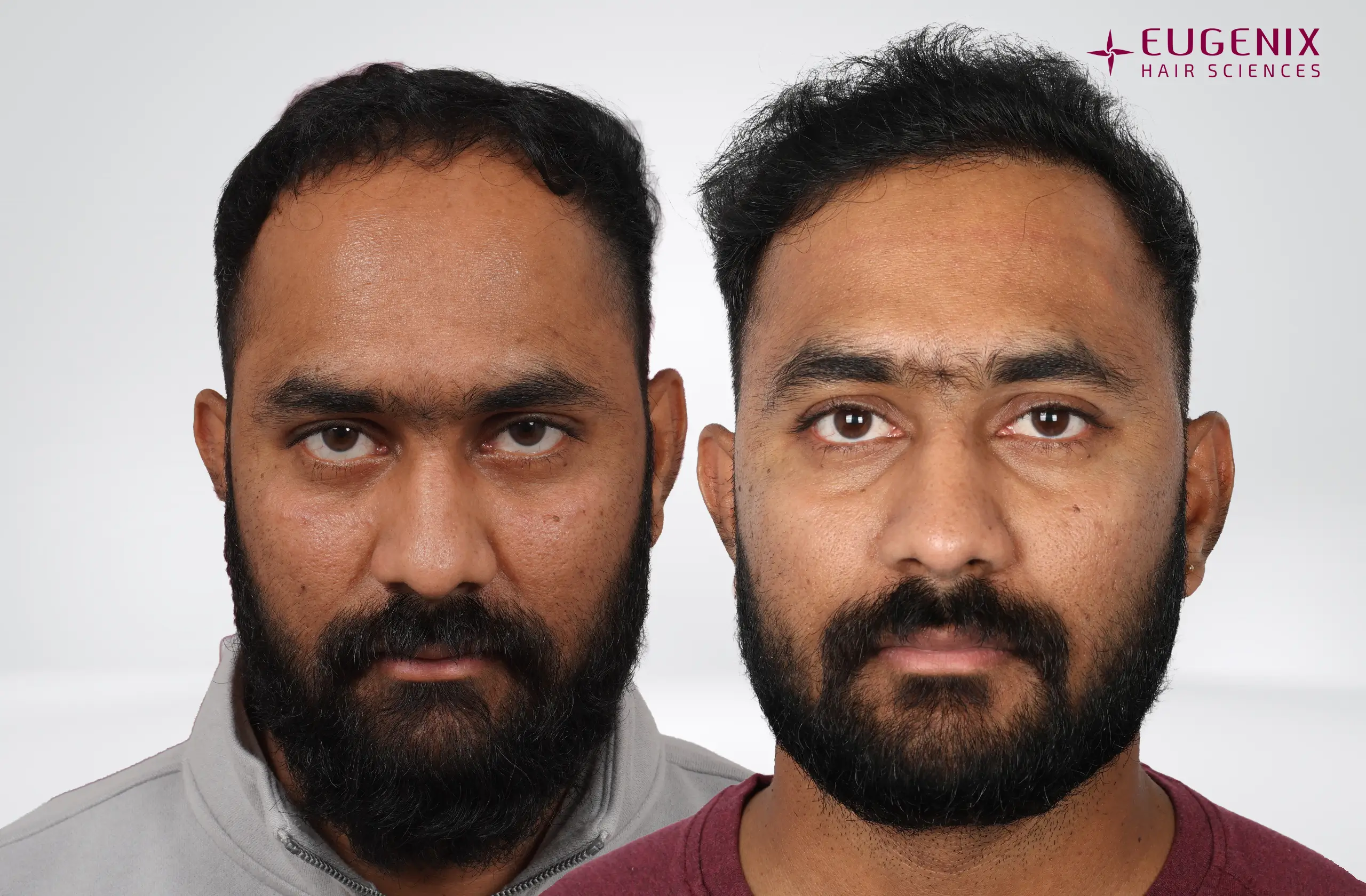 Vineel Jeejula Before and After Front copy