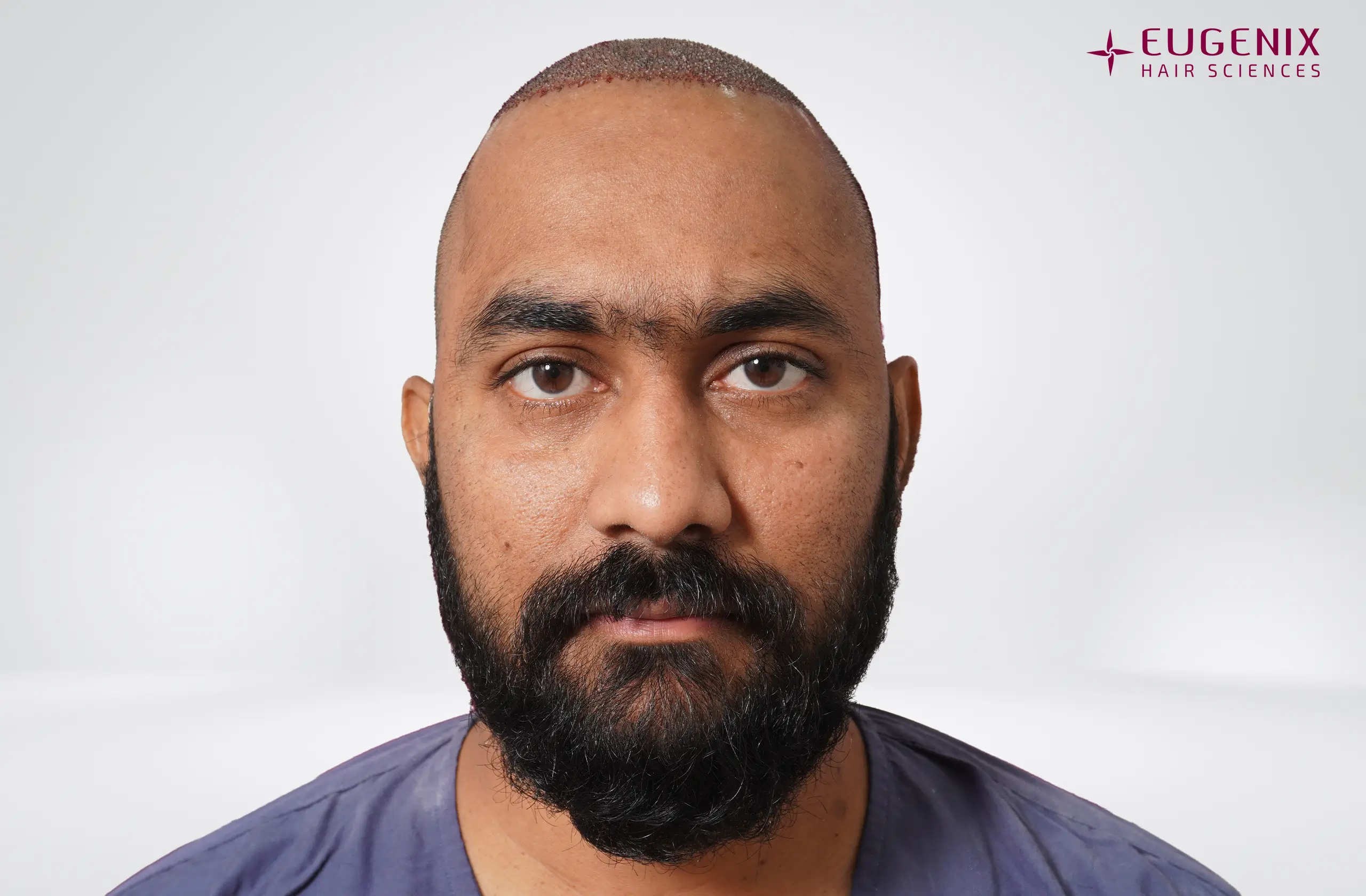 Vineel Jeejula Post-op Front copy