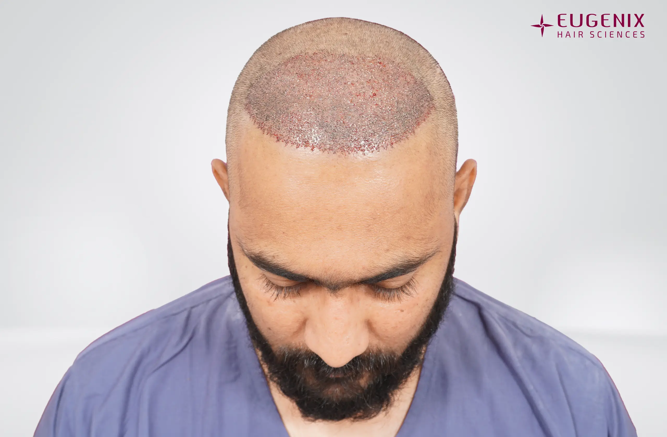 Vineel Jeejula Post-op Head Down copy