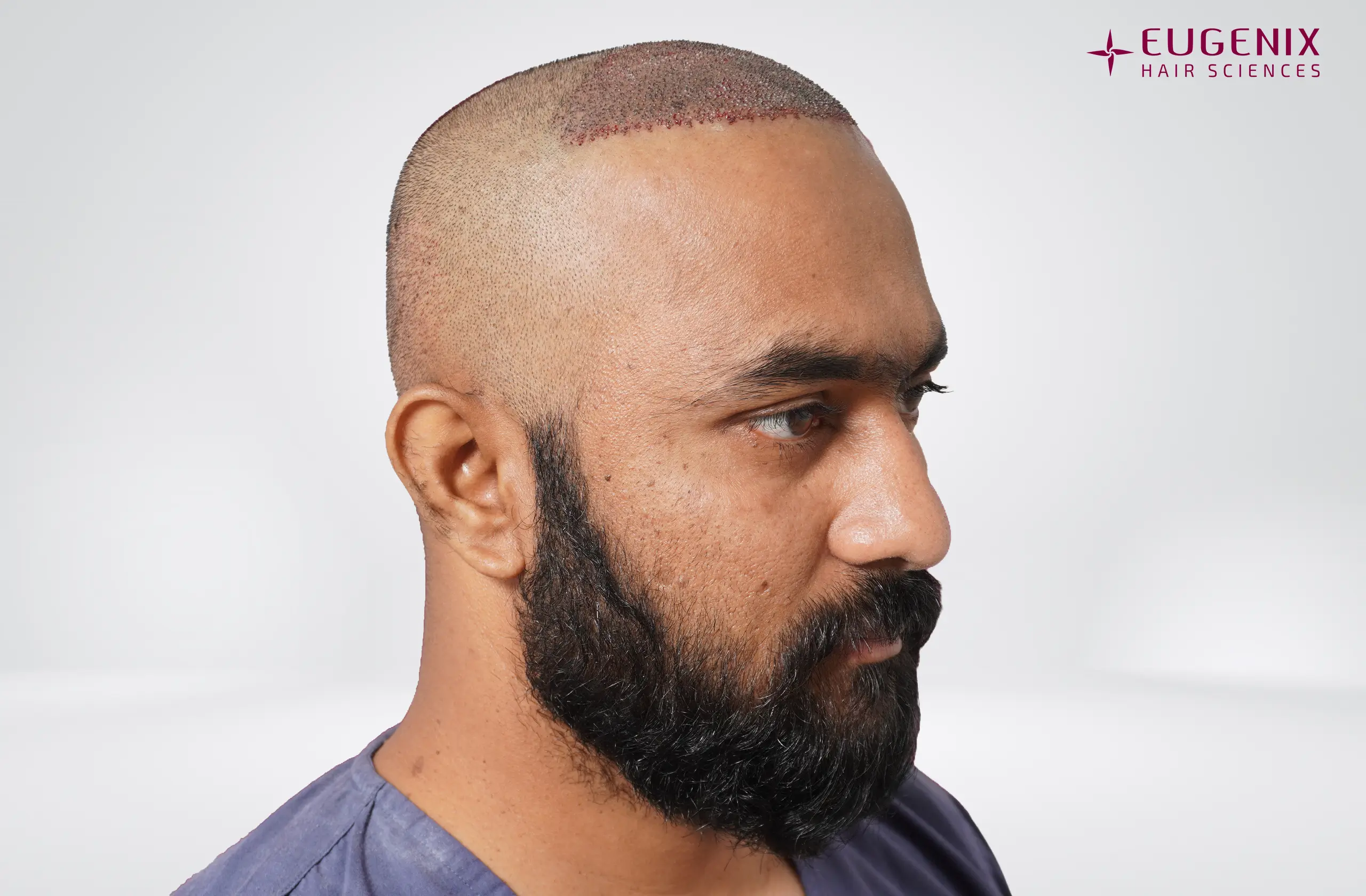 Vineel Jeejula Post-op Leftt copy