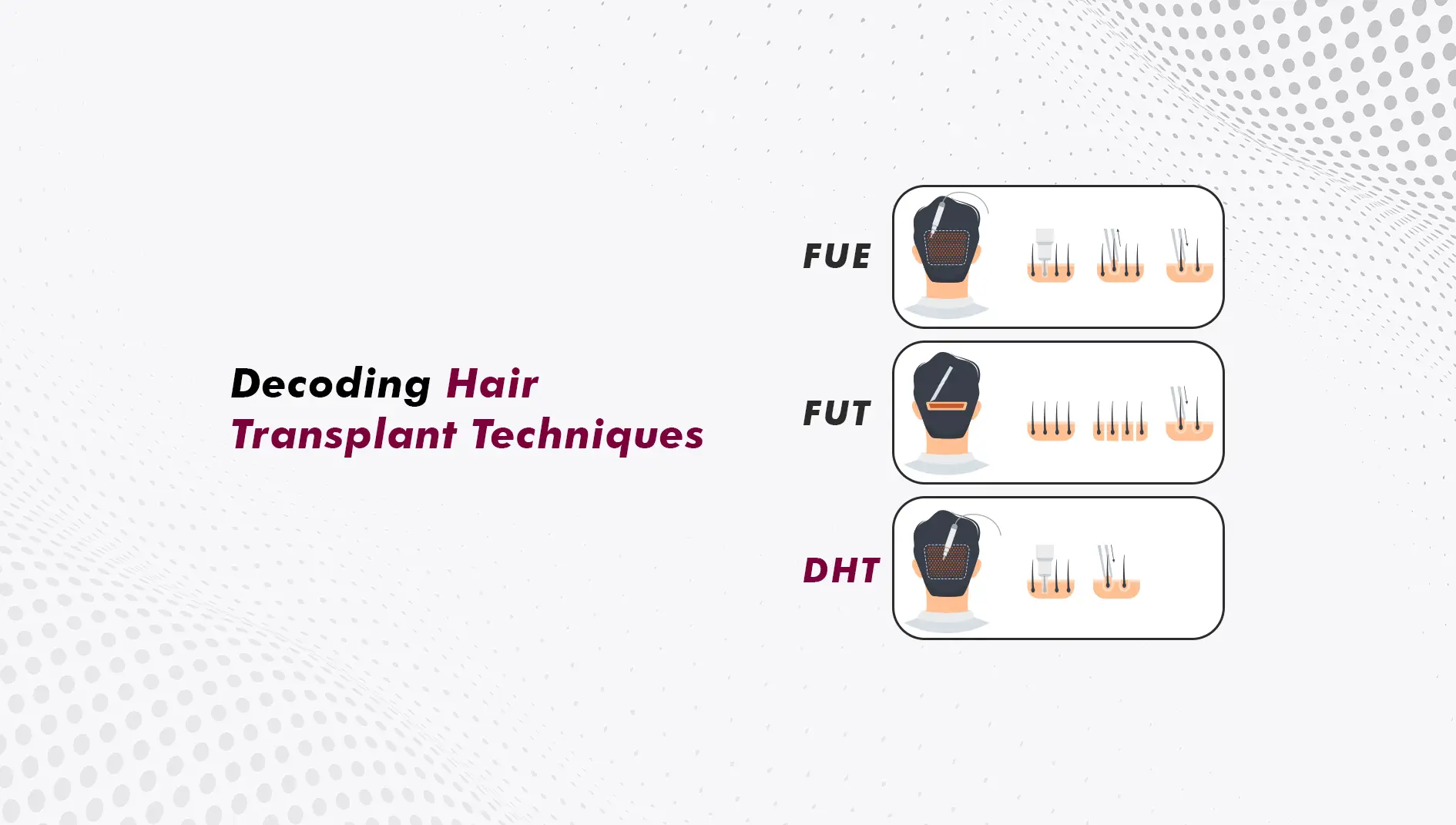 QHT Hair Transplant, Bio-FUE, Sapphire and DHI: What These Branded Technique Names Actually Mean