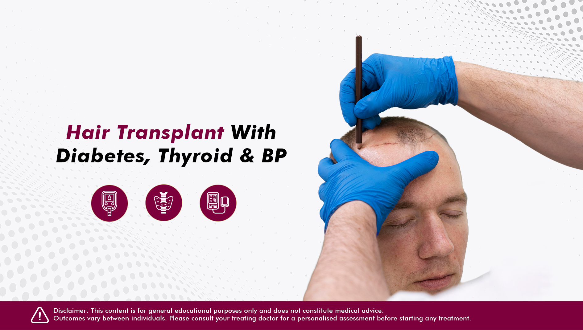 Can You Have a Hair Transplant With Diabetes, Thyroid or High Blood Pressure?