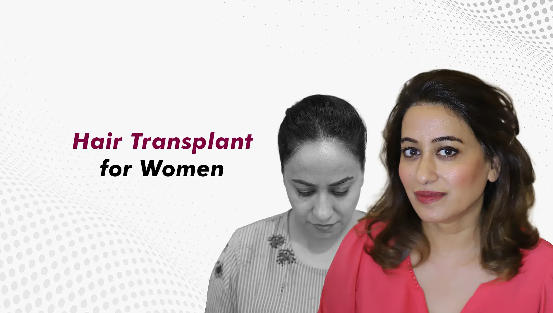 Can Women Do Hair Transplant? What Is Different for Female Patients