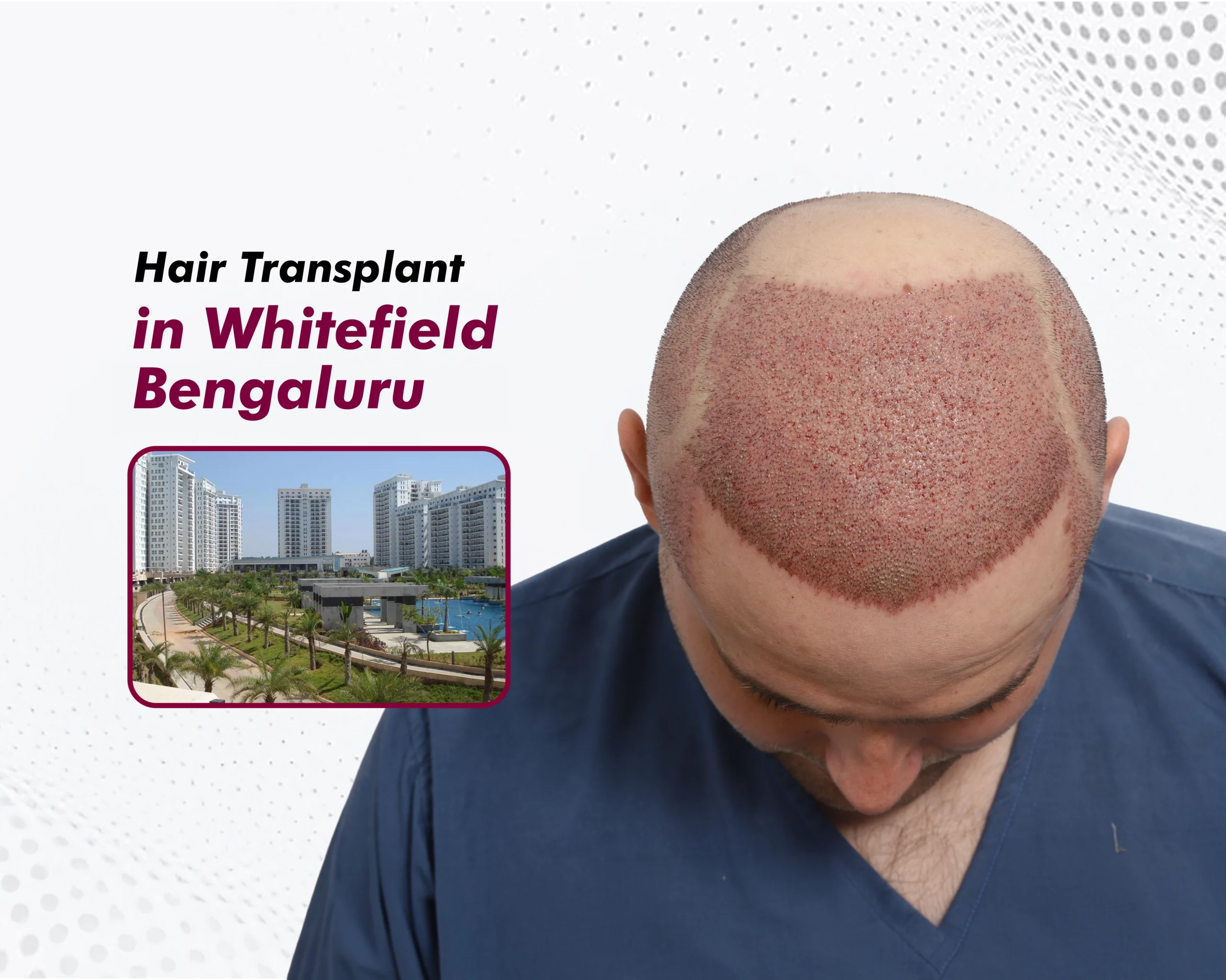 Hair-Transplant-in-Bengaluru (Whitefield) copy (2)
