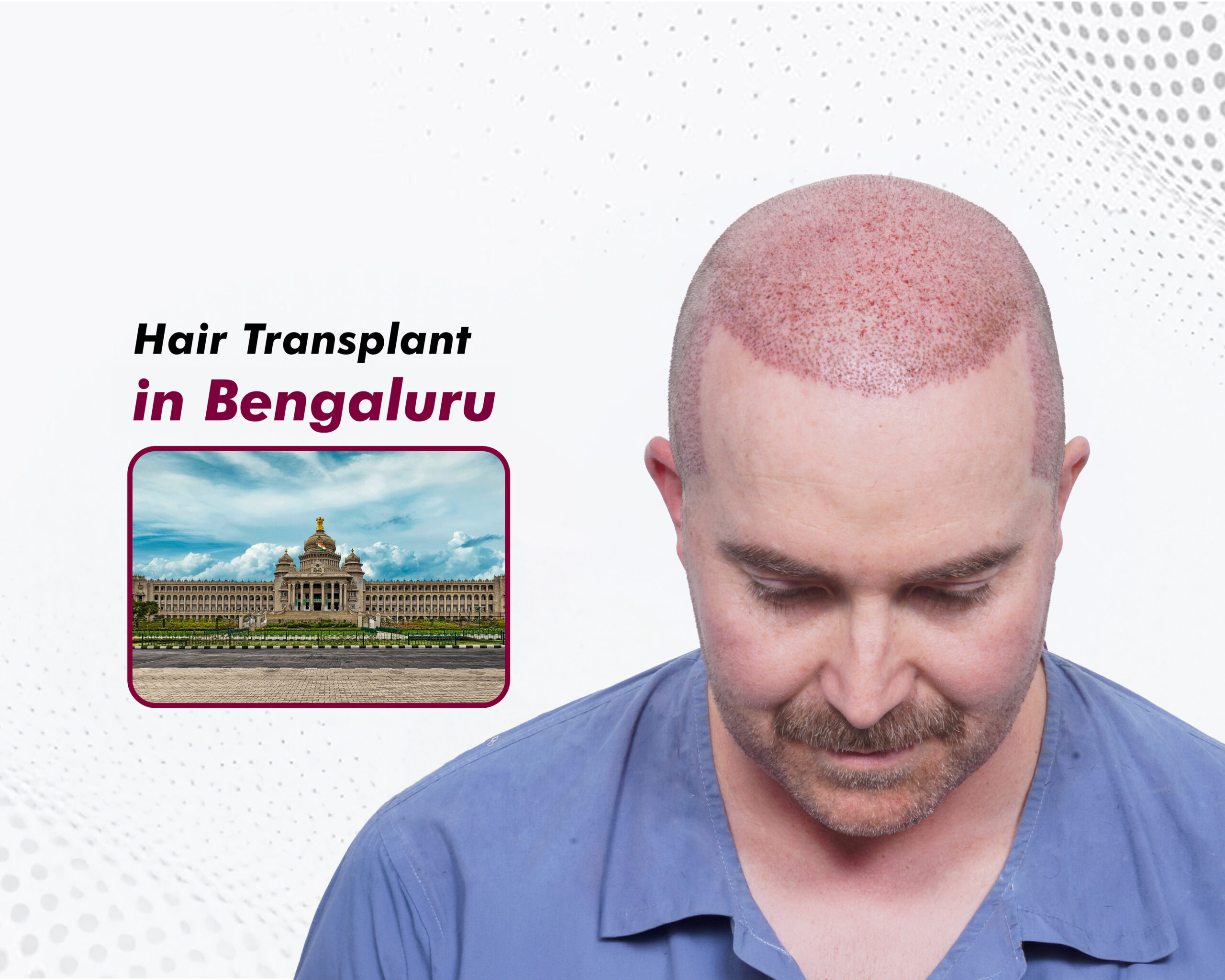 Hair-Transplant-in-Bengaluru copy.jpg (2)