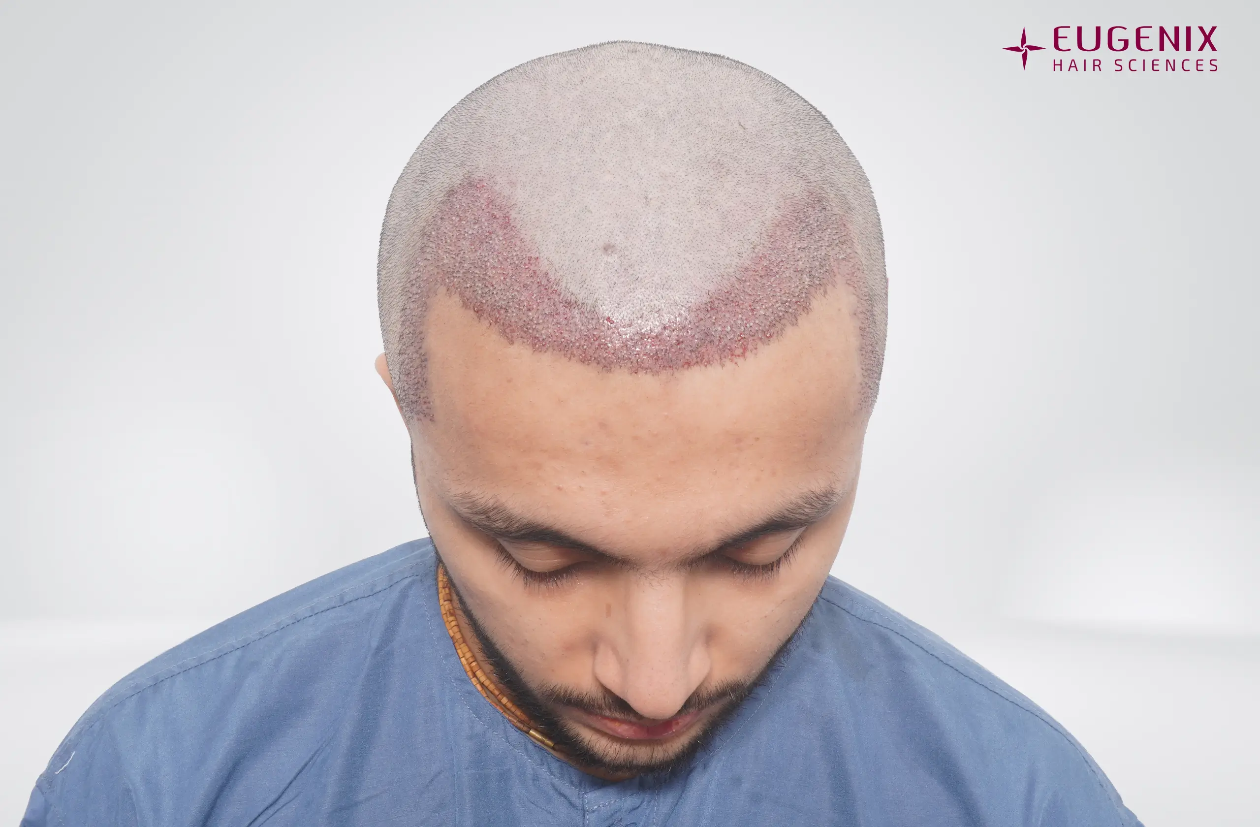 Rohan Post-op Head Down copy