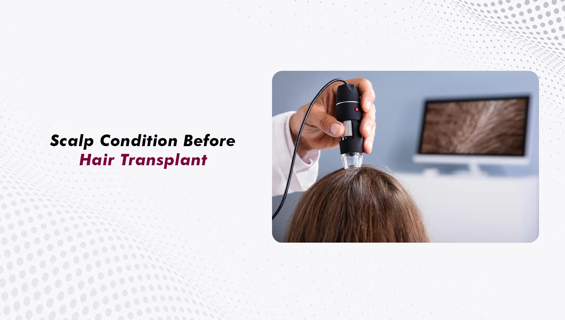 Scalp Conditions Before Hair Transplant Surgery: Dandruff, Psoriasis and What Needs Treating First