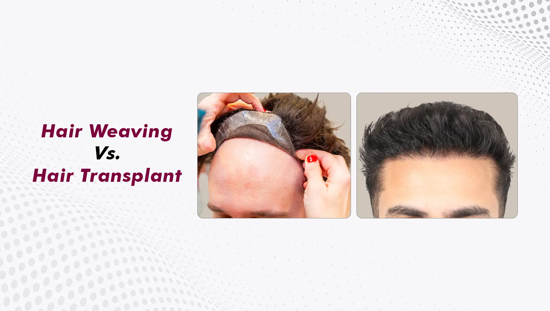 Hair Weaving Cost vs Hair Transplant: What Are You Really Paying For?