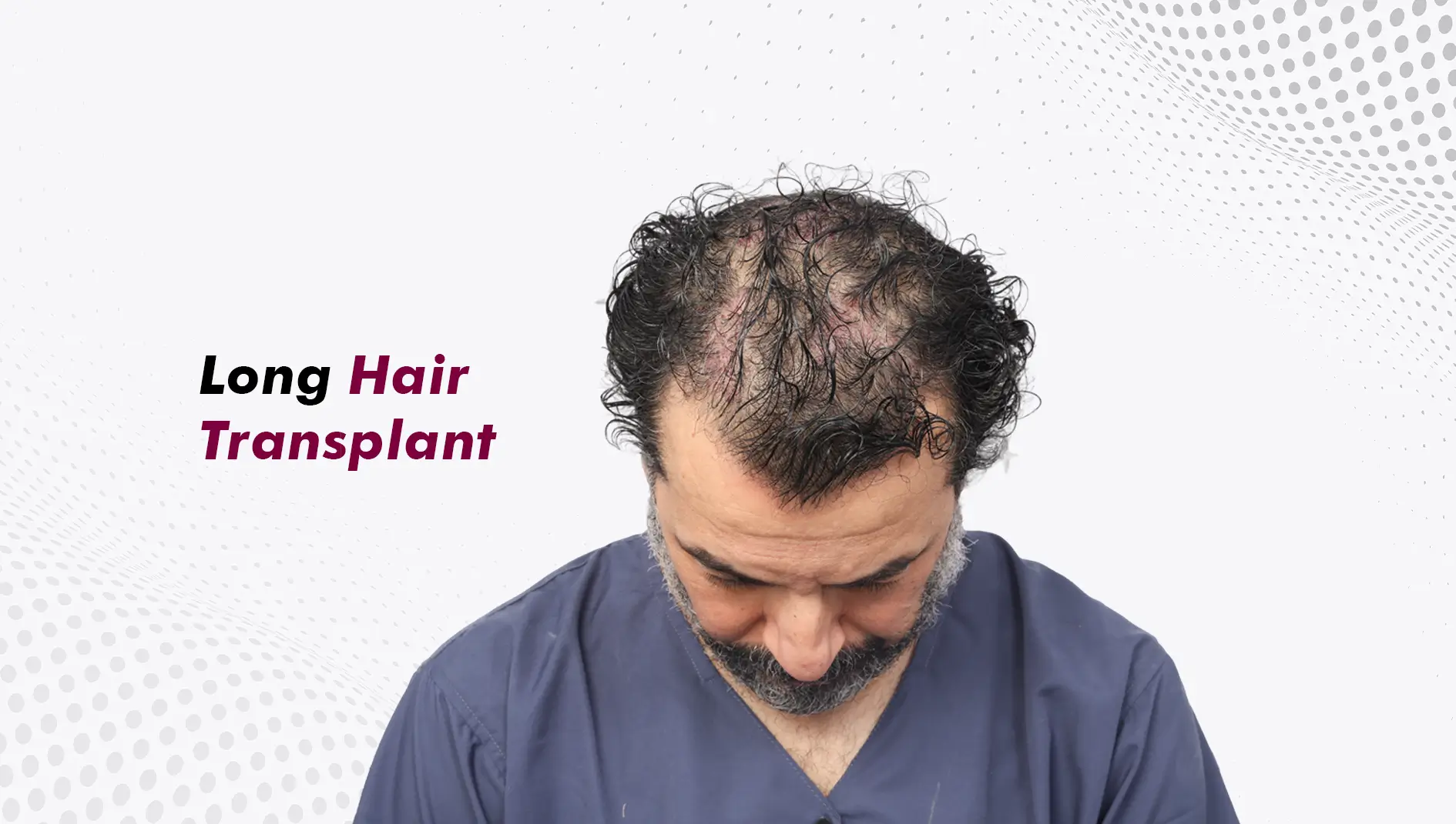 Long Hair Transplant: Can You Keep Your Length During an Unshaven Hair Transplant?